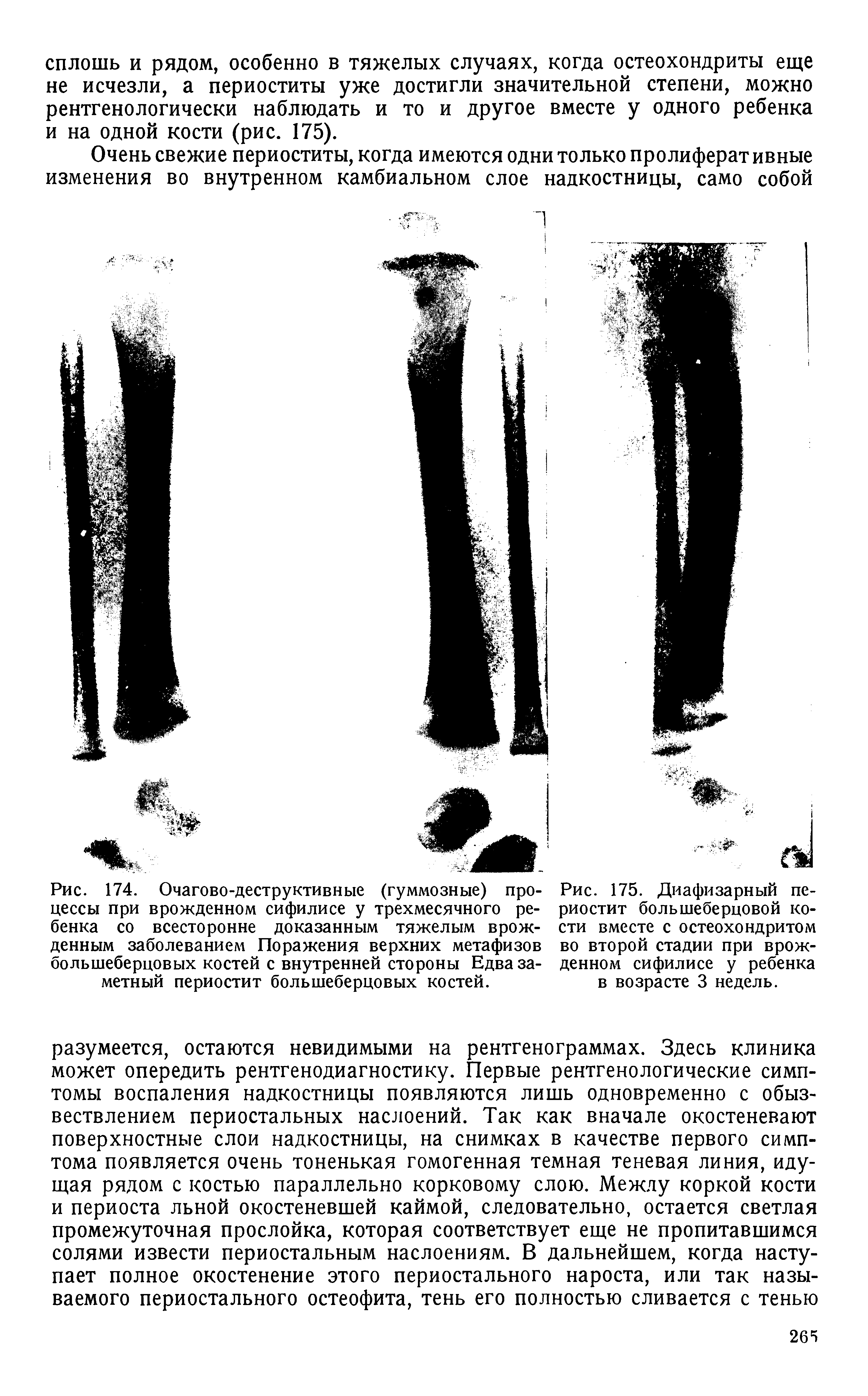 Рис. 175. Диафизарный периостит большеберцовой кости вместе с остеохондритом во второй стадии при врожденном сифилисе у ребенка в возрасте 3 недель.