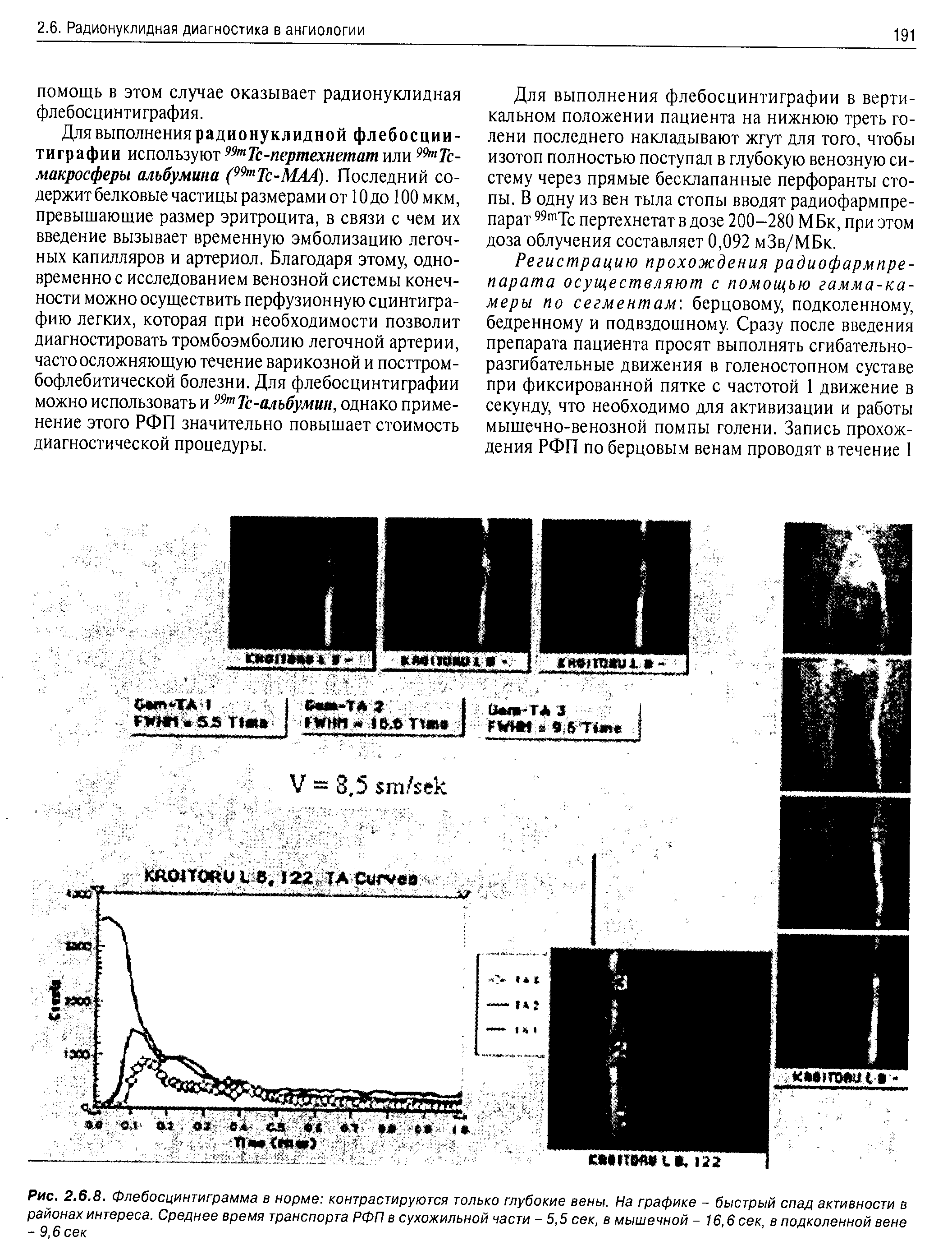 Рис. 2.6.8. Флебосцинтиграмма в норме контрастируются только глубокие вены. На графике - быстрый спад активности в районах интереса. Среднее время транспорта РФП в сухожильной части - 5,5 сек, в мышечной - 16,беек, в подколенной вене -9,6 сек...