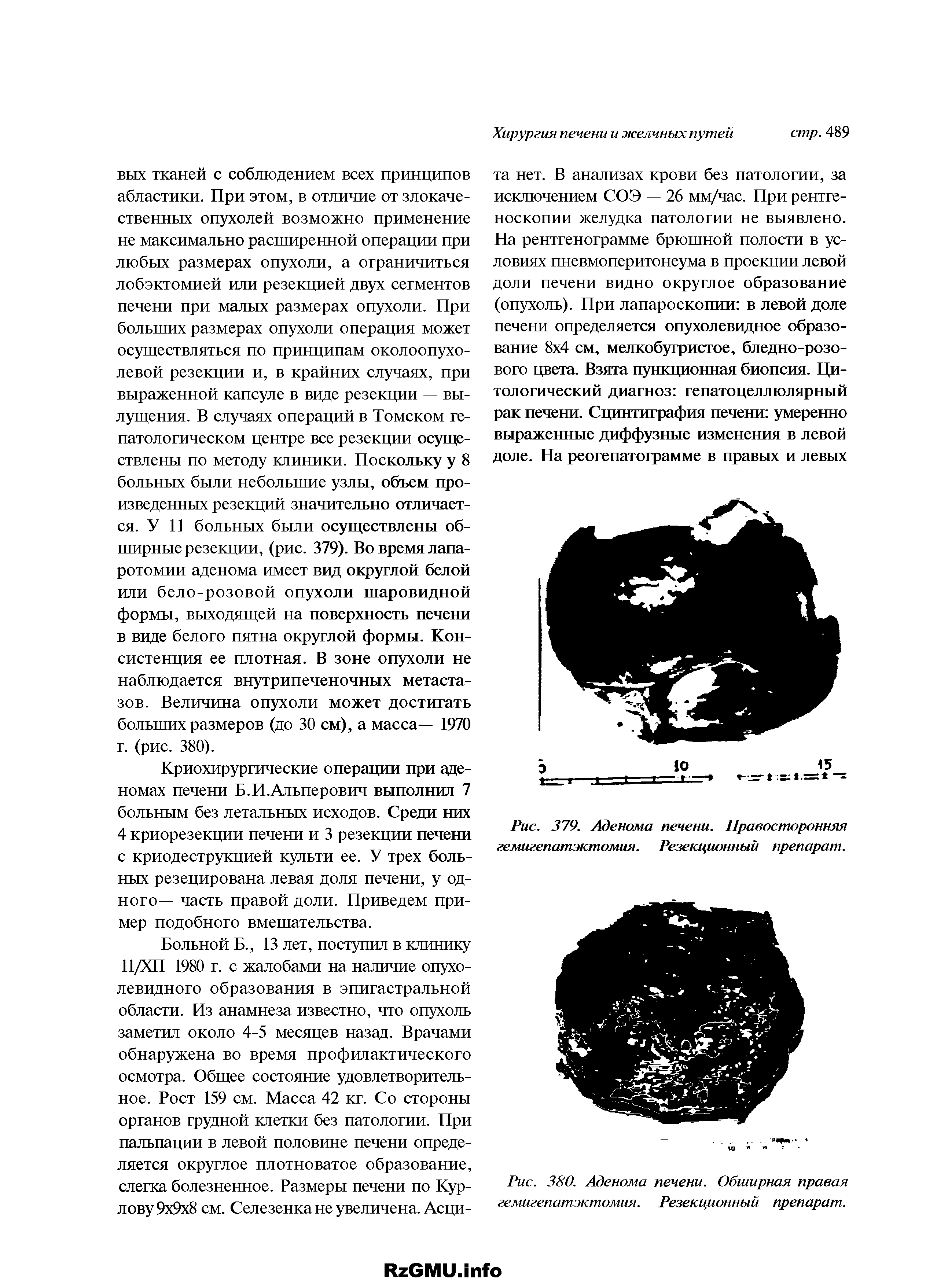 Рис. 379. Аденома печени. Правосторонняя гемигепатэктомия. Резекционный препарат.