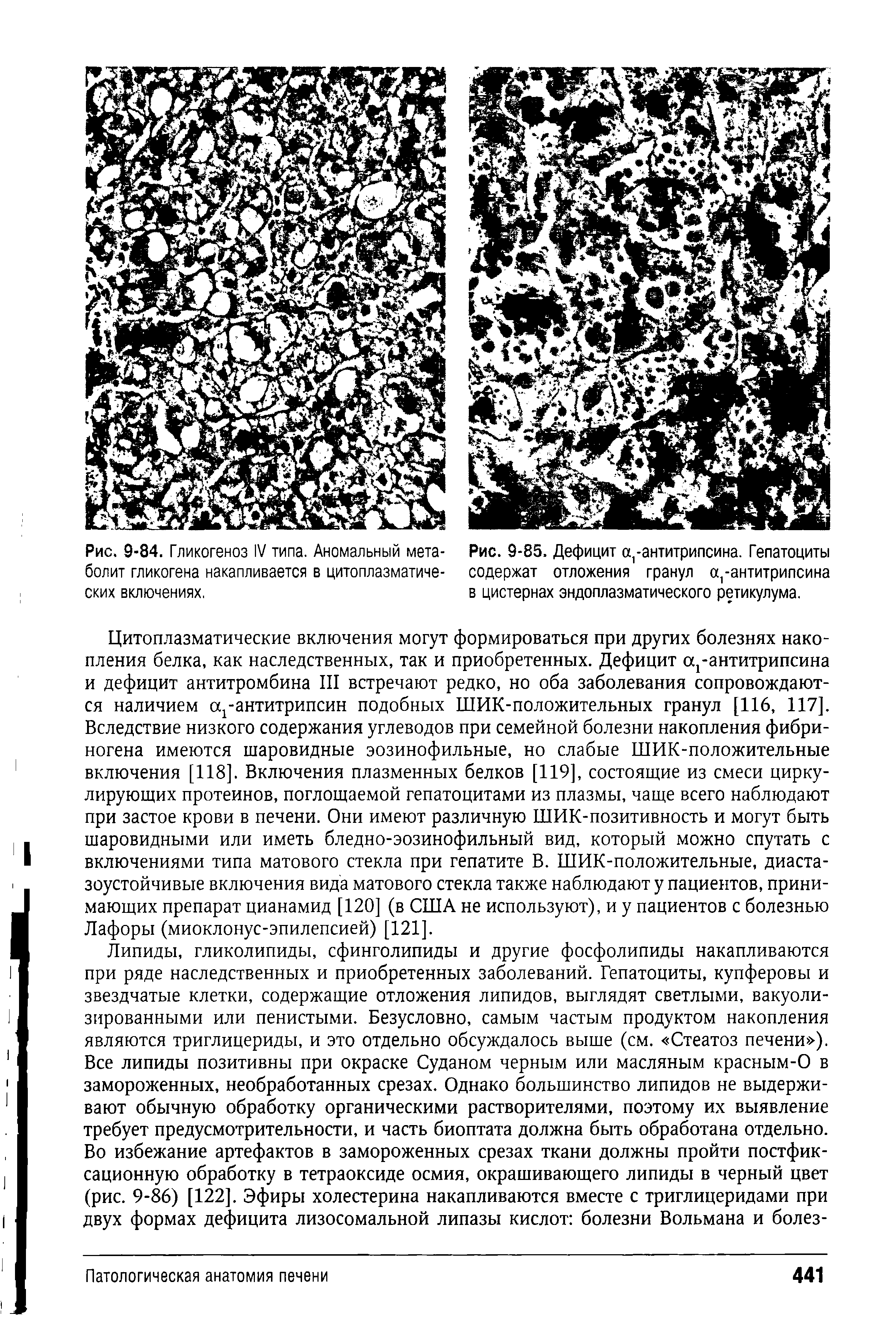 Рис. 9-85. Дефицит а антитрипсина. Гепатоциты содержат отложения гранул а,-антитрипсина в цистернах эндоплазматического ретикулума.