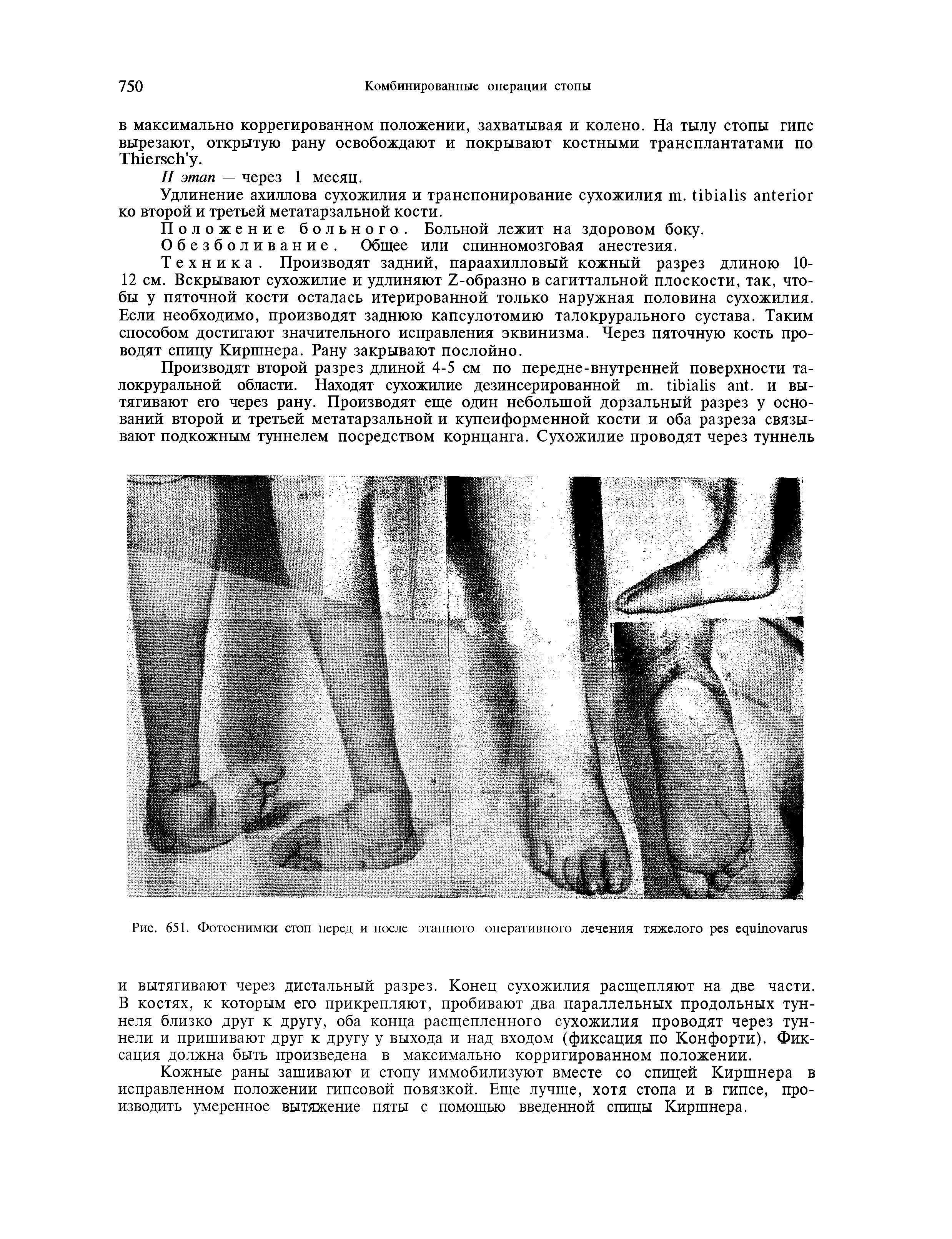 Рис. 651. Фотоснимки стоп перед и после этапного оперативного лечения тяжелого ...