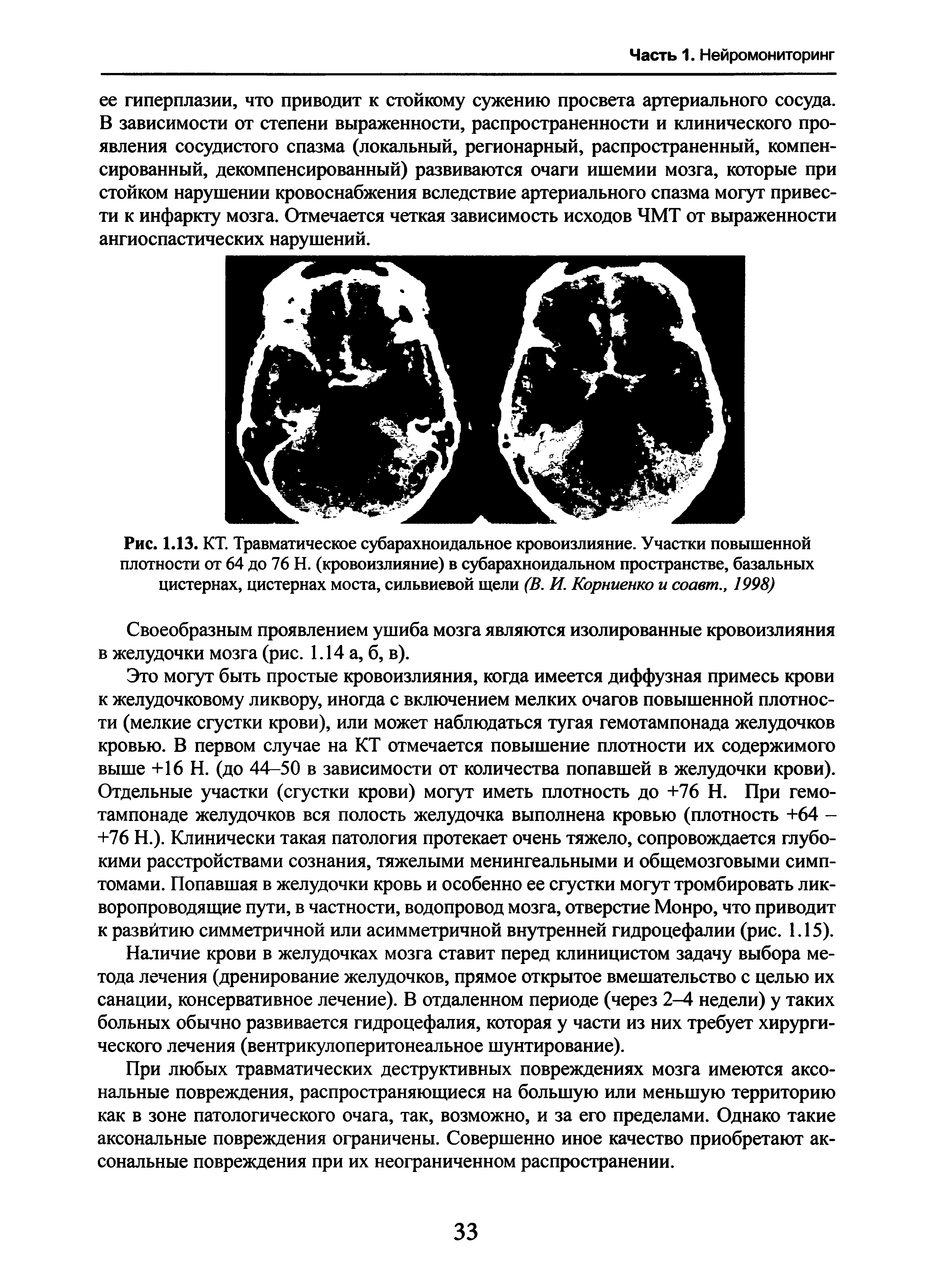 Рис. 1.13. КТ. Травматическое субарахноидальное кровоизлияние. Участки повышенной плотности от 64 до 76 Н. (кровоизлияние) в субарахноидальном пространстве, базальных цистернах, цистернах моста, сильвиевой щели (В. И. Корниенко и соавт., 1998)...