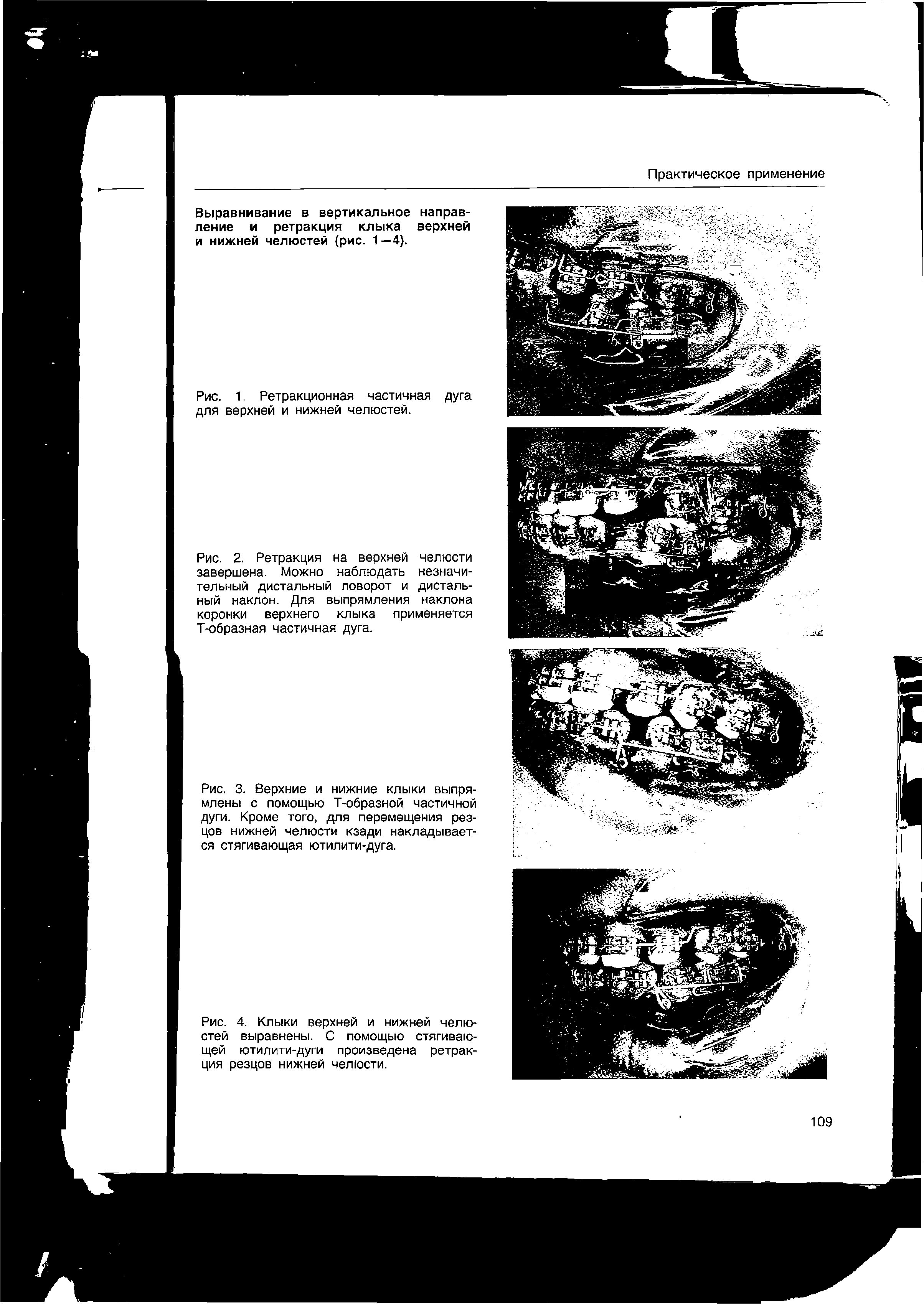 Рис. 4. Клыки верхней и нижней челюстей выравнены. С помощью стягивающей ютилити-дуги произведена ретракция резцов нижней челюсти.