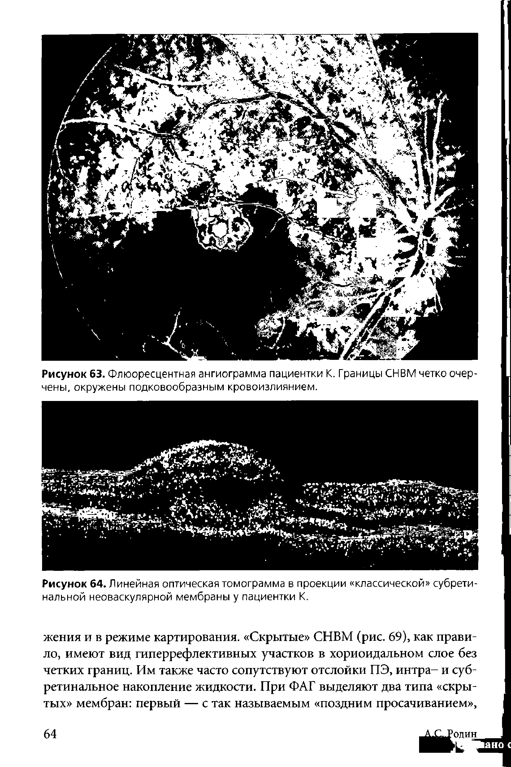 Рисунок 64. Линейная оптическая томограмма в проекции классической субретинальной неоваскулярной мембраны у пациентки К.