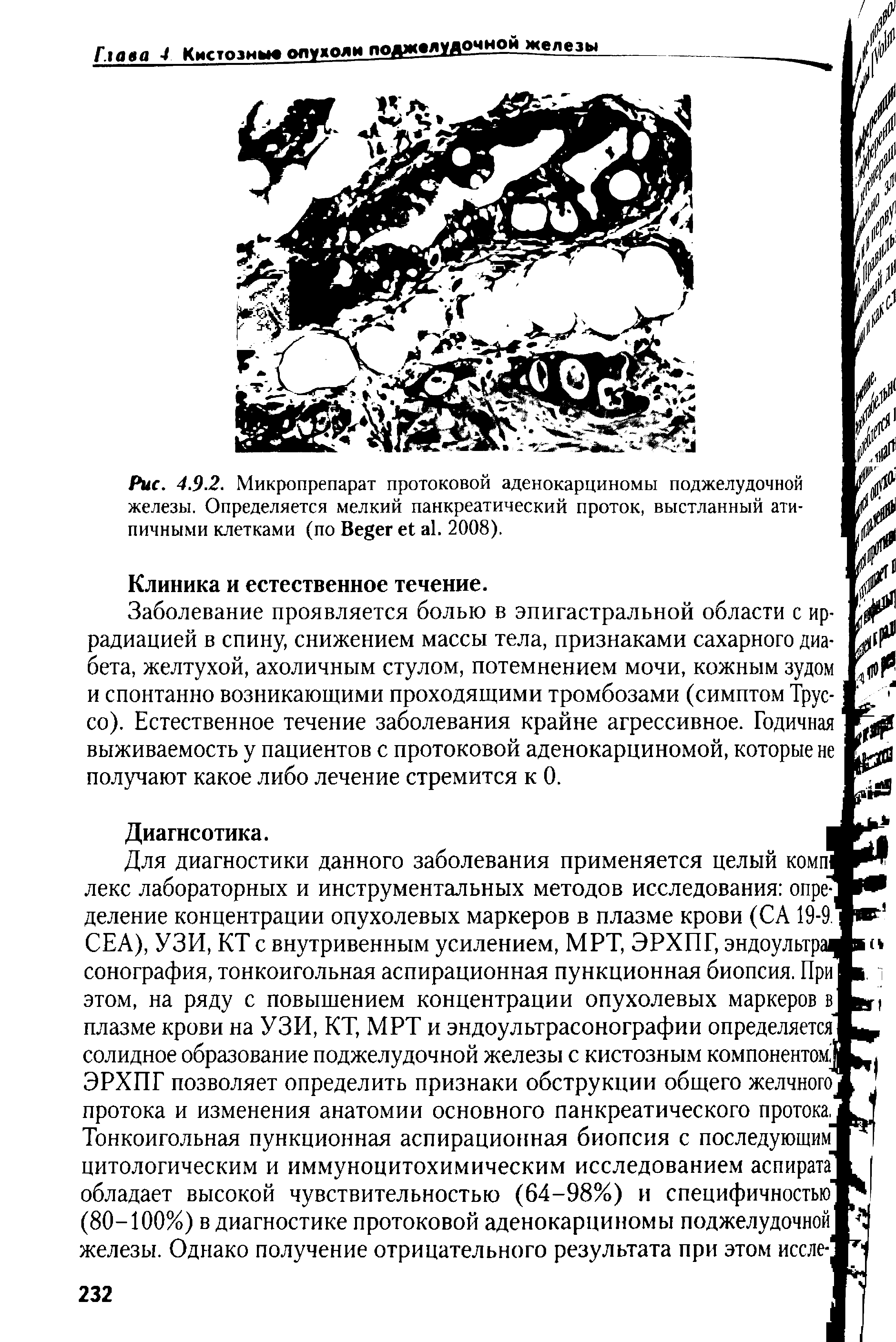 Рис. 4.9.2. Микропрепарат протоковой аденокарциномы поджелудочной железы. Определяется мелкий панкреатический проток, выстланный атипичными клетками (по 1 ег е1 а1. 2008).