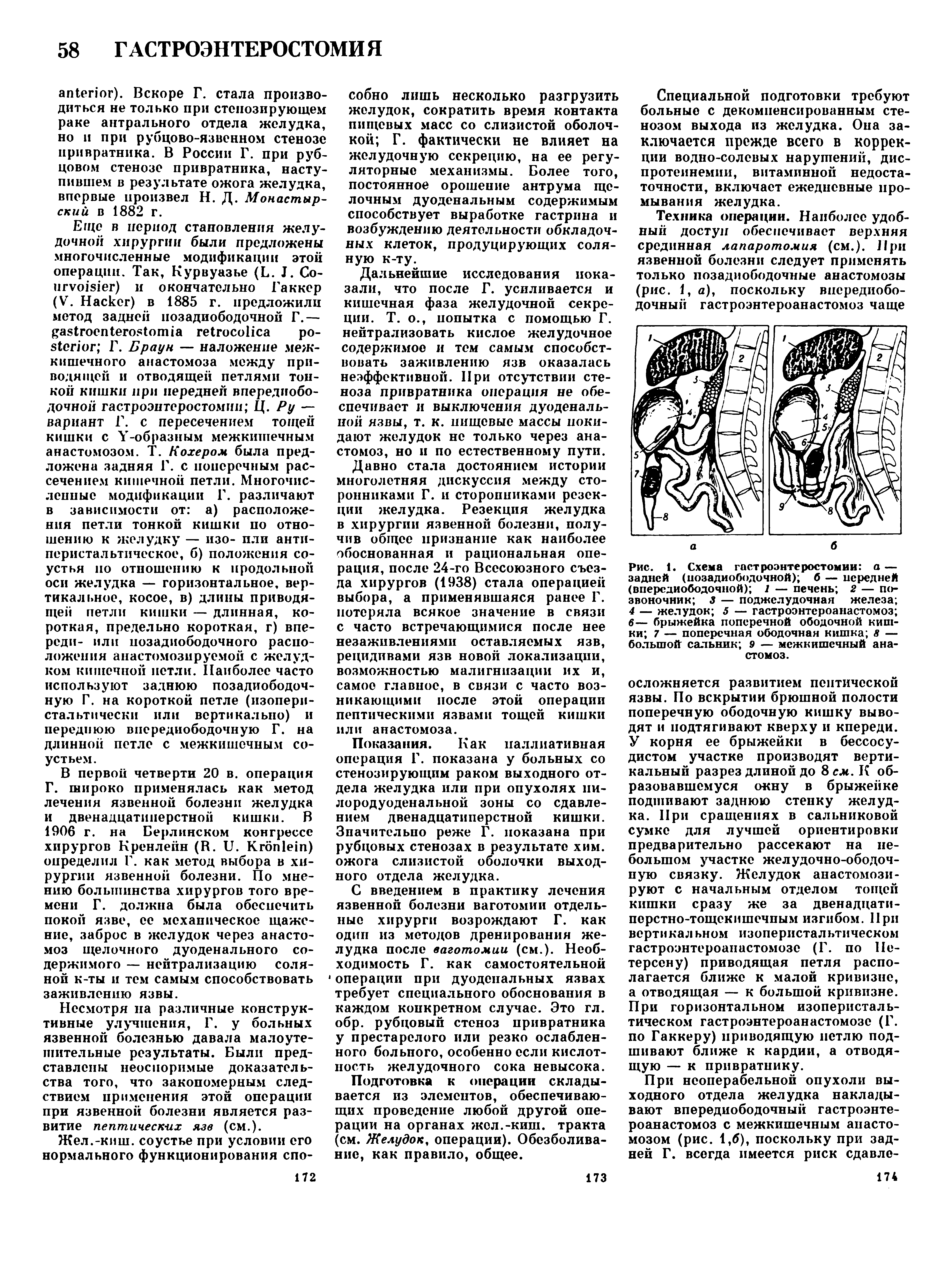 Рис. 1. Схема гастроэнтеростомии а — задней (позадиободочной) б — передней (впереди ободочной) 1 — печень 2 — позвоночник 3 — поджелудочная железа 4 — желудок 5 — гастроэнтероанастомоз 6— брыжейка поперечной ободочной кишки 7 — поперечная ободочная кишка 8 — большой сальник 9 — межкишечный анастомоз.