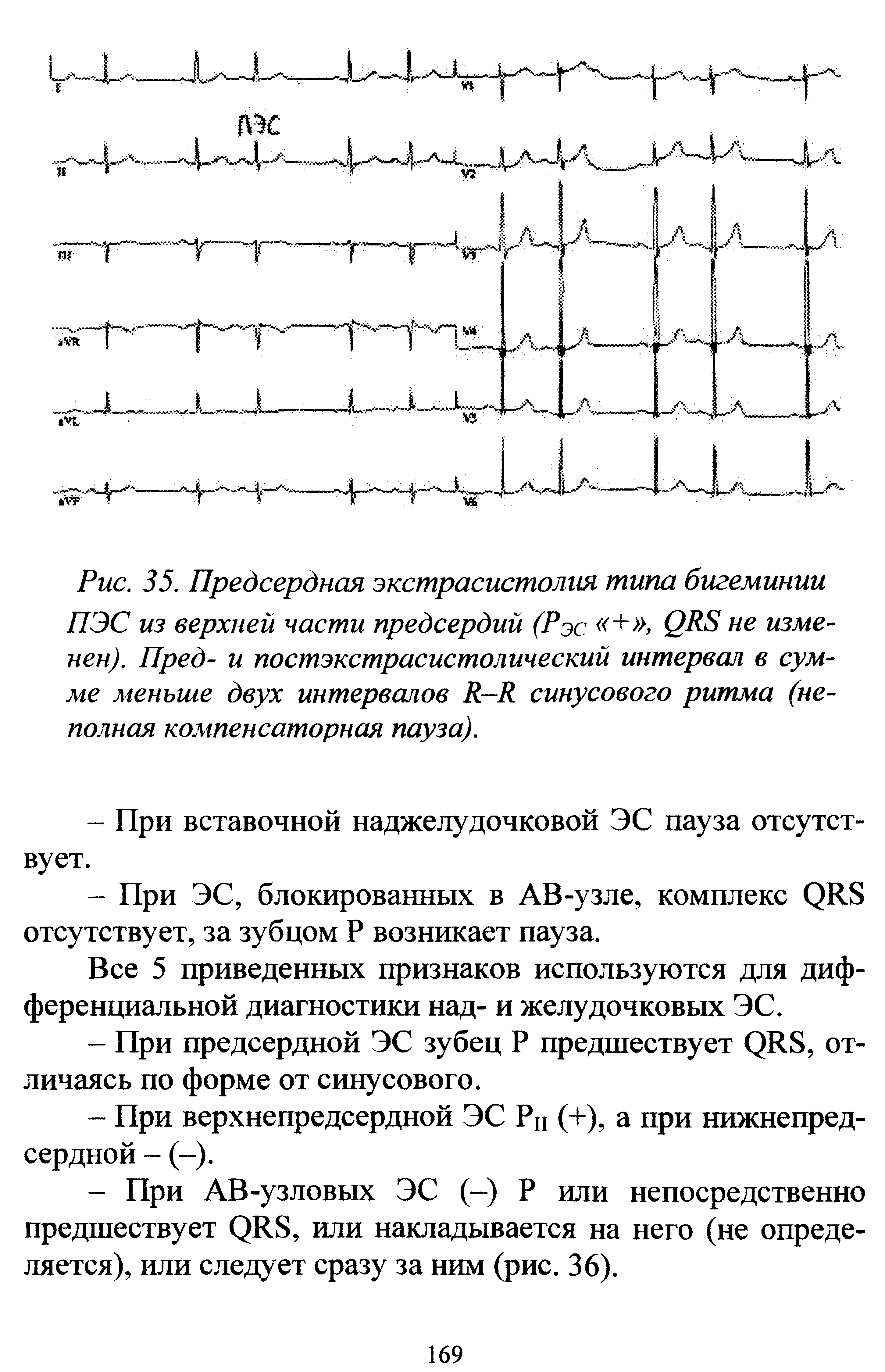 Рис. 35. Предсердная экстрасистолия типа бигеминии ПЭС из верхней части предсердий (Рэс + > (2 8 не изменен). Пред- и постэкстрасистолический интервал в сумме меньше двух интервалов синусового ритма (неполная компенсаторная пауза).