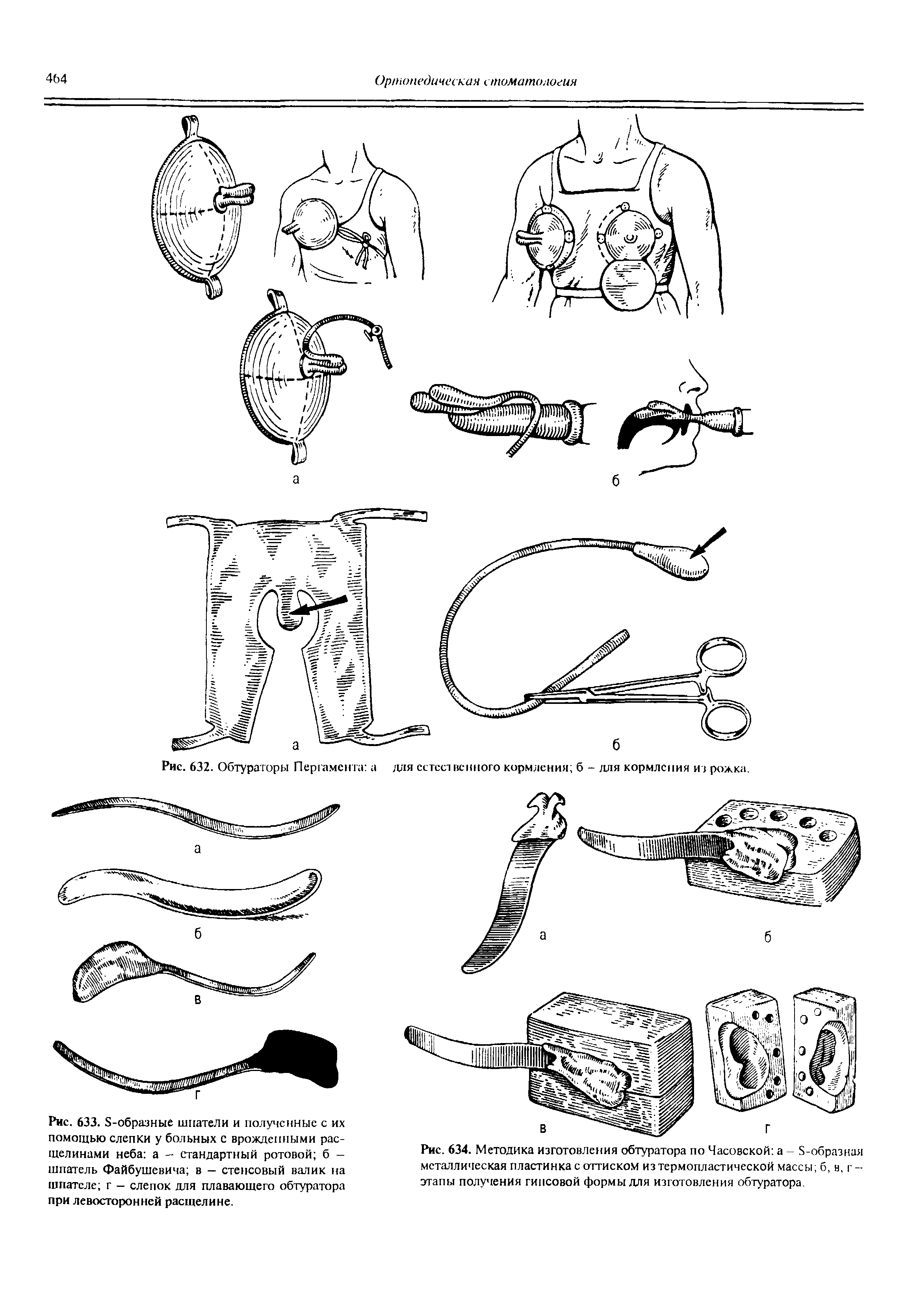 Рис. 634. Методика изготовления обтуратора по Часовской а - 5-образная металлическая пластинка с оттиском из термопластической массы б, и, г -этапы получения гипсовой формы для изготовления обтуратора.