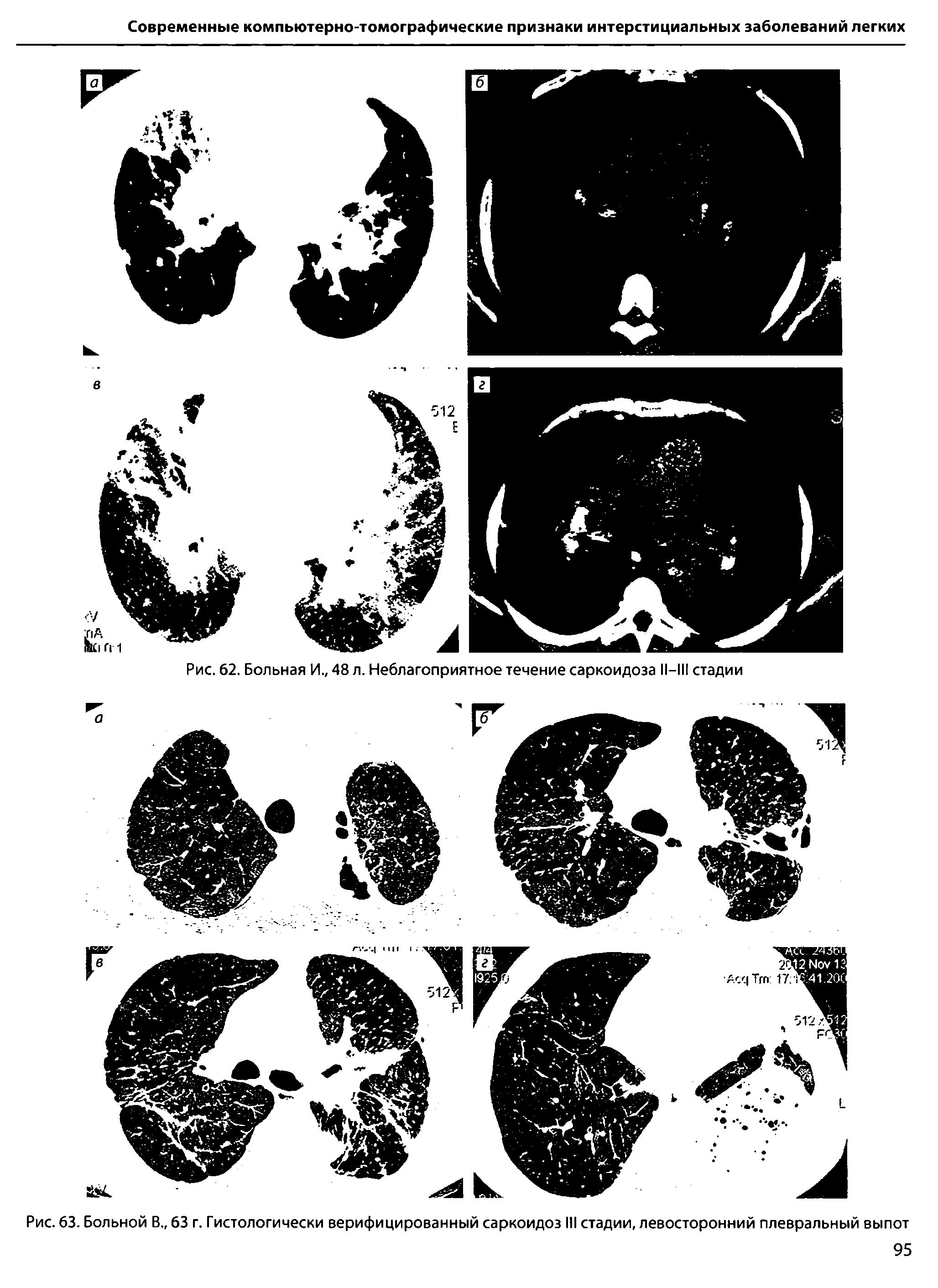 Рис. 63. Больной В., 63 г. Гистологически верифицированный саркоидоз III стадии, левосторонний плевральный выпот...