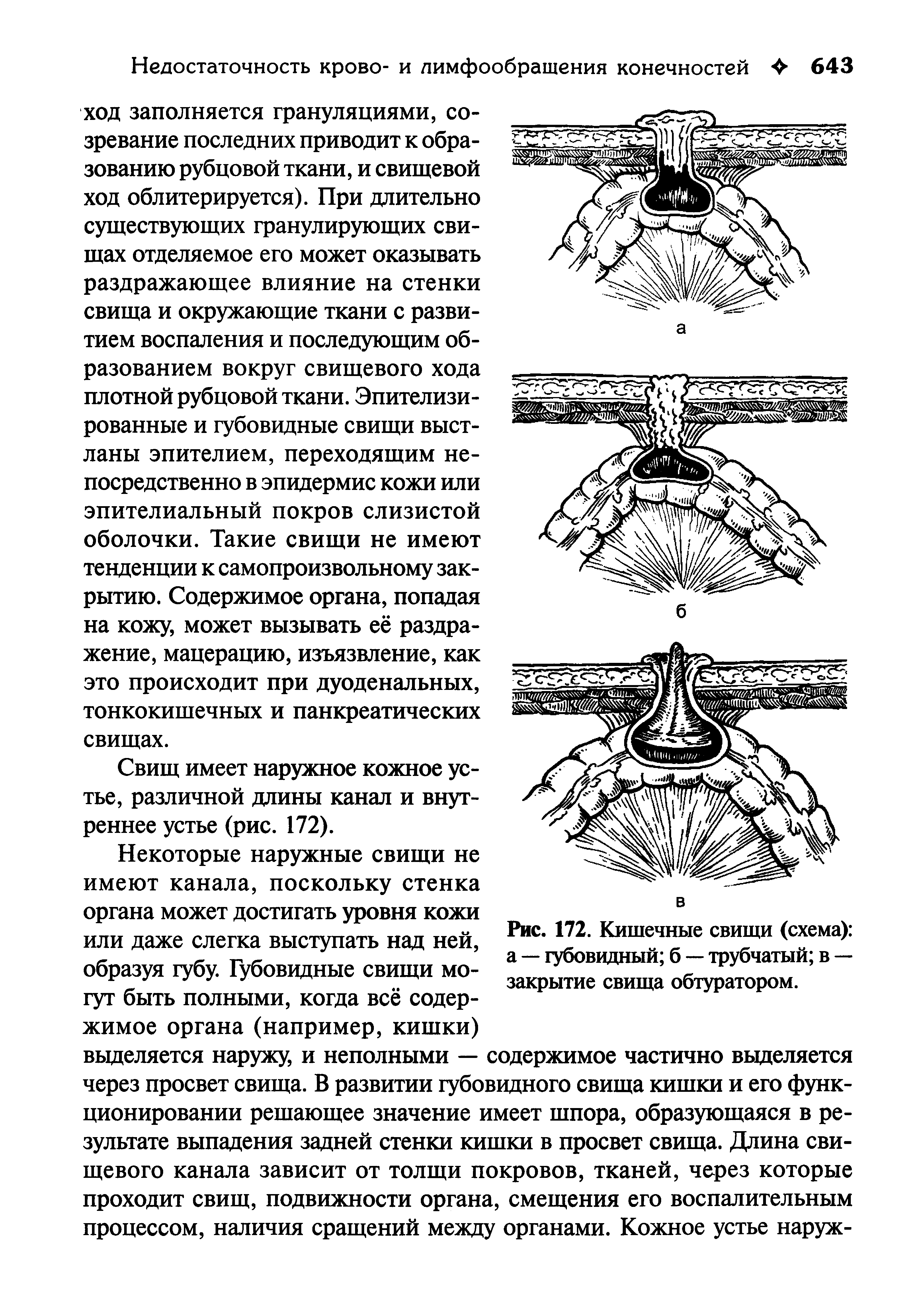 Рис. 172. Кишечные свищи (схема) а — губовидный б — трубчатый в — закрытие свища обтуратором.