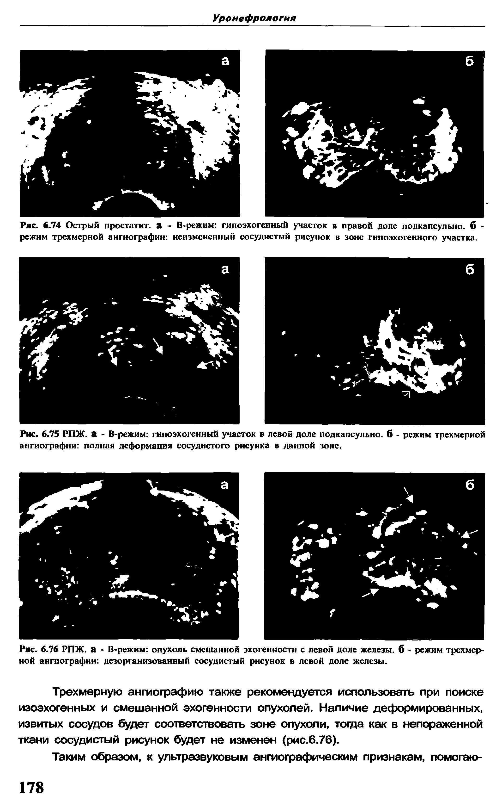 Рис. 6.76 РПЖ. а - В -режим опухоль смешанной эхогенности с левой доле железы, б - режим трехмерной ангиографии дезорганизованный сосудистый рисунок в левой доле железы.