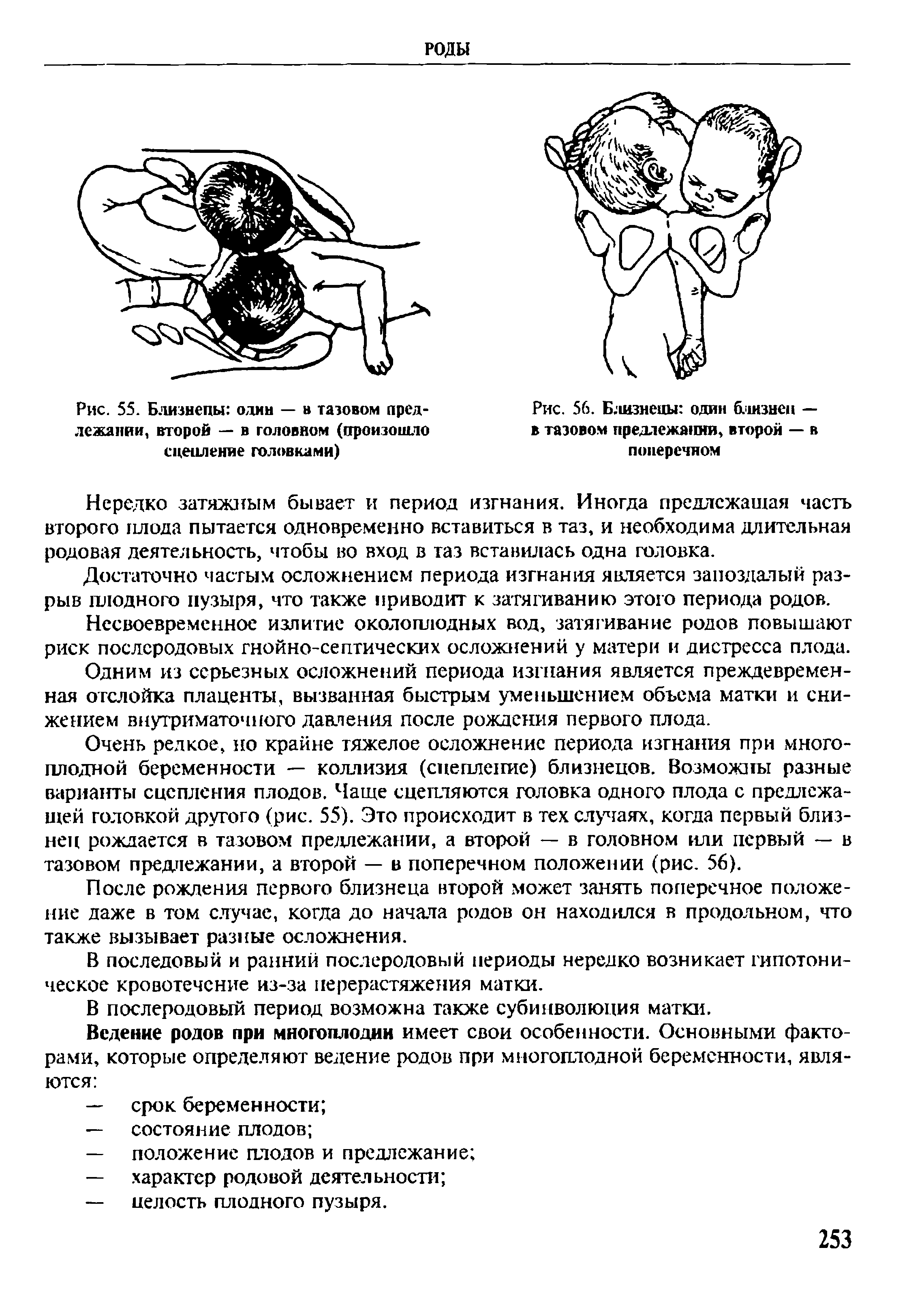 Рис. 56. Б.1изнецы один близнец — в тазовом предлежании, второй — в поперечном...