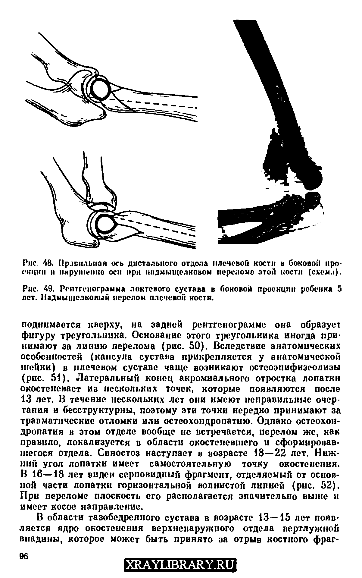 Рис. 49. Рентгенограмма локтевого сустава в боковой проекции ребенка 5 лот. Надмыщелковый перелом плечевой коств.