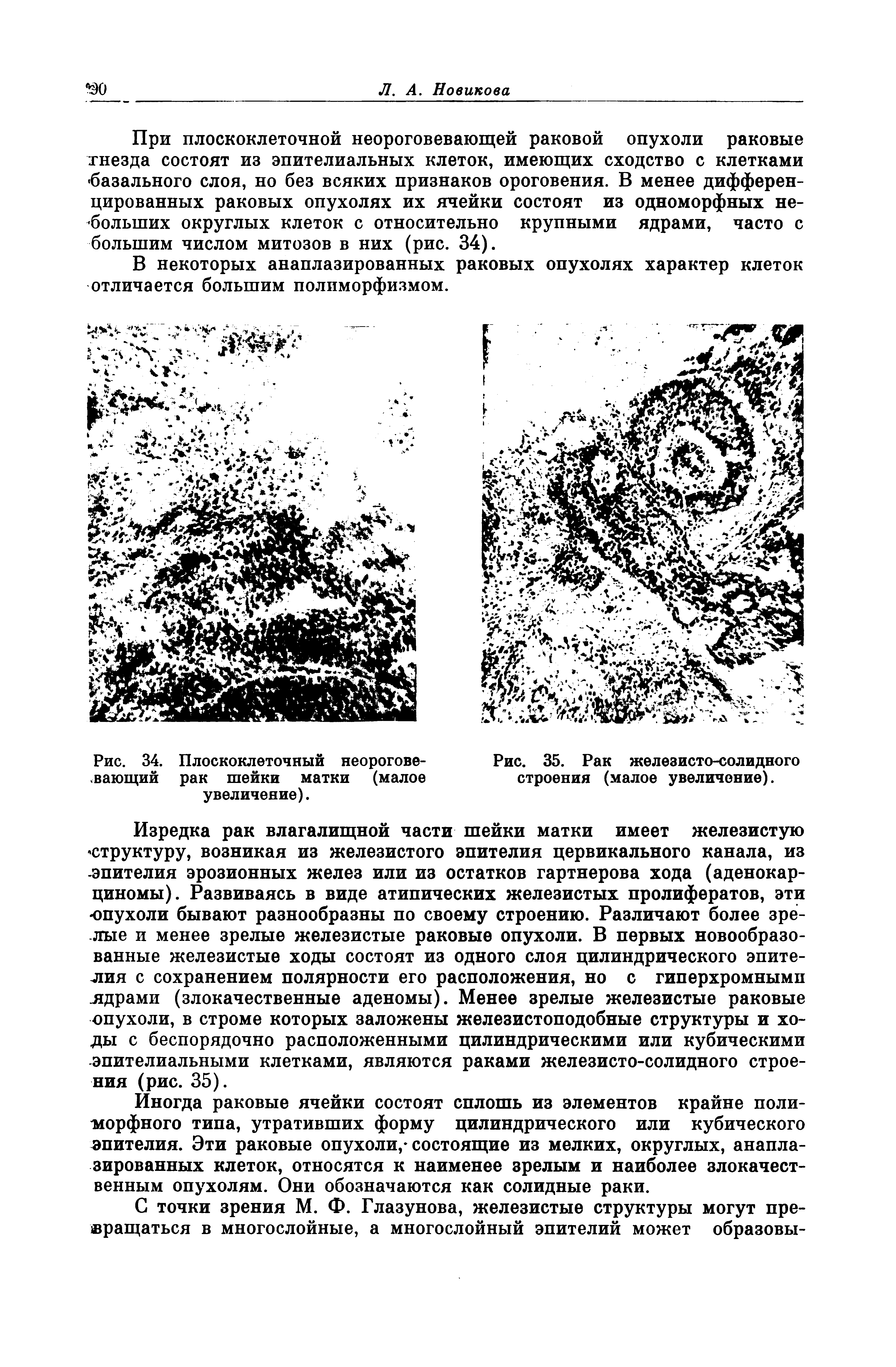 Рис. 34. Плоскоклеточный неорогове-вающий рак шейки матки (малое увеличение).