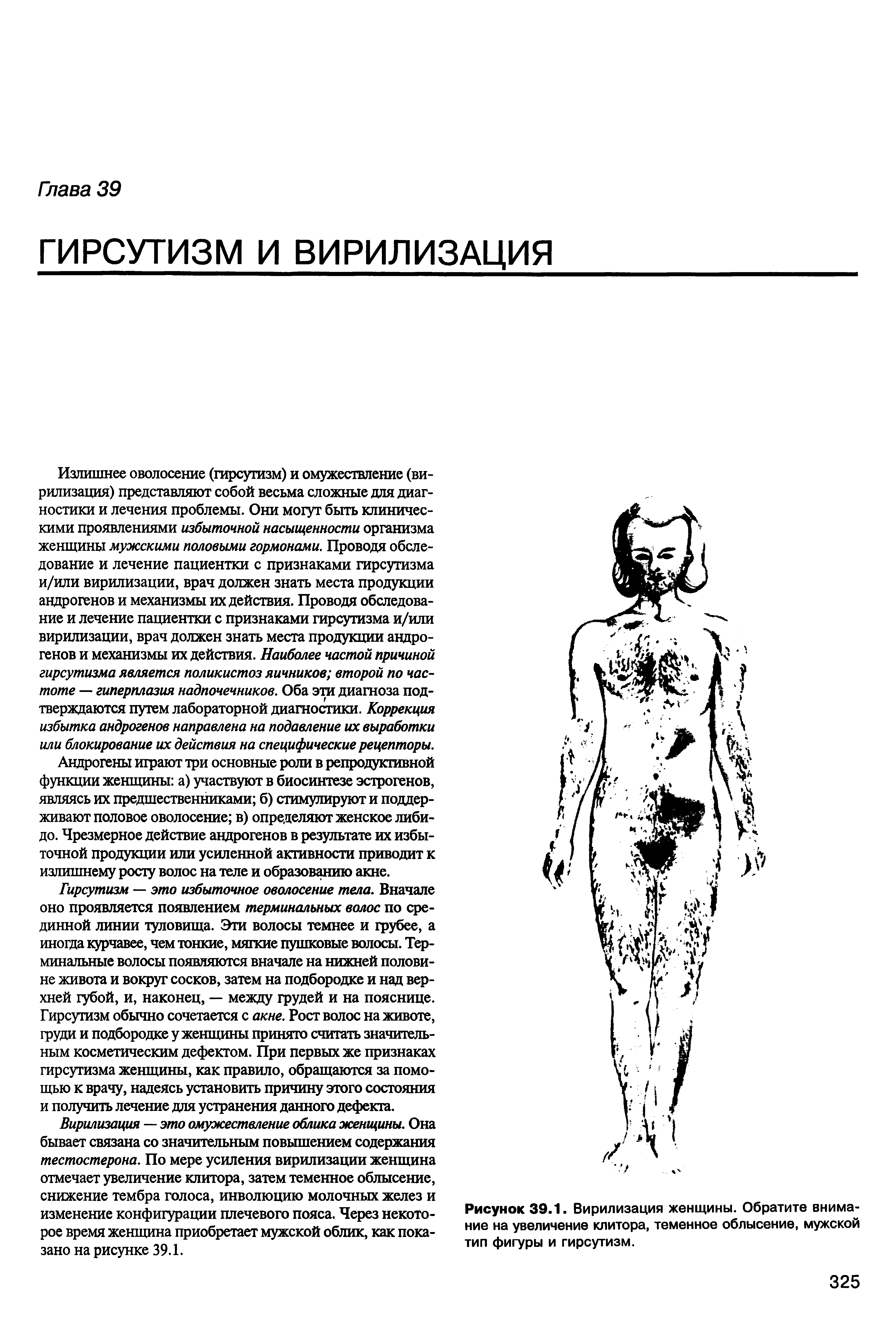 Рисунок 39.1. Вирилизация женщины. Обратите внимание на увеличение клитора, теменное облысение, мужской тип фигуры и гирсутизм.