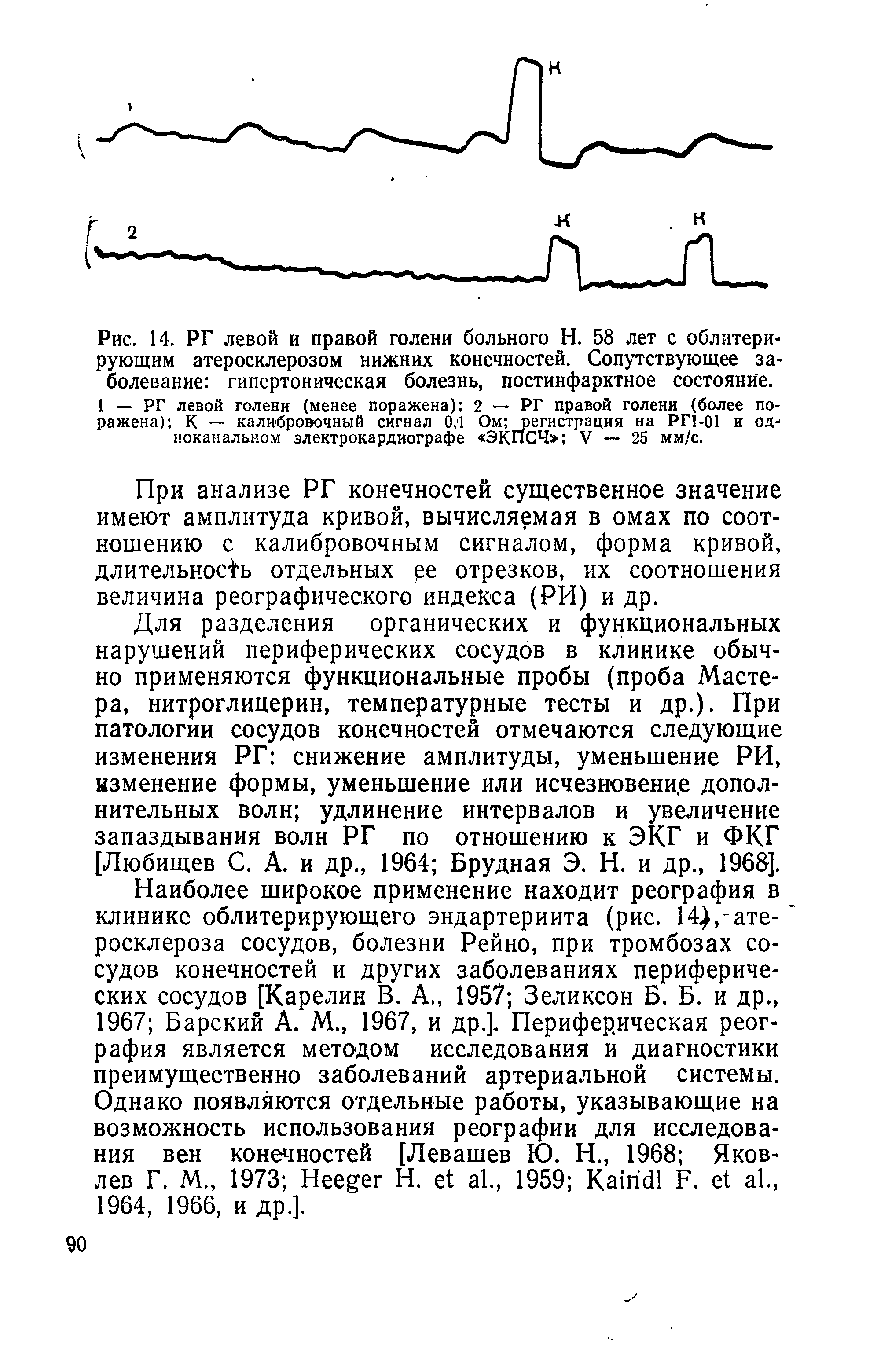 Рис. 14. РГ левой и правой голени больного Н. 58 лет с облитерирующим атеросклерозом нижних конечностей. Сопутствующее заболевание гипертоническая болезнь, постинфарктное состояние.