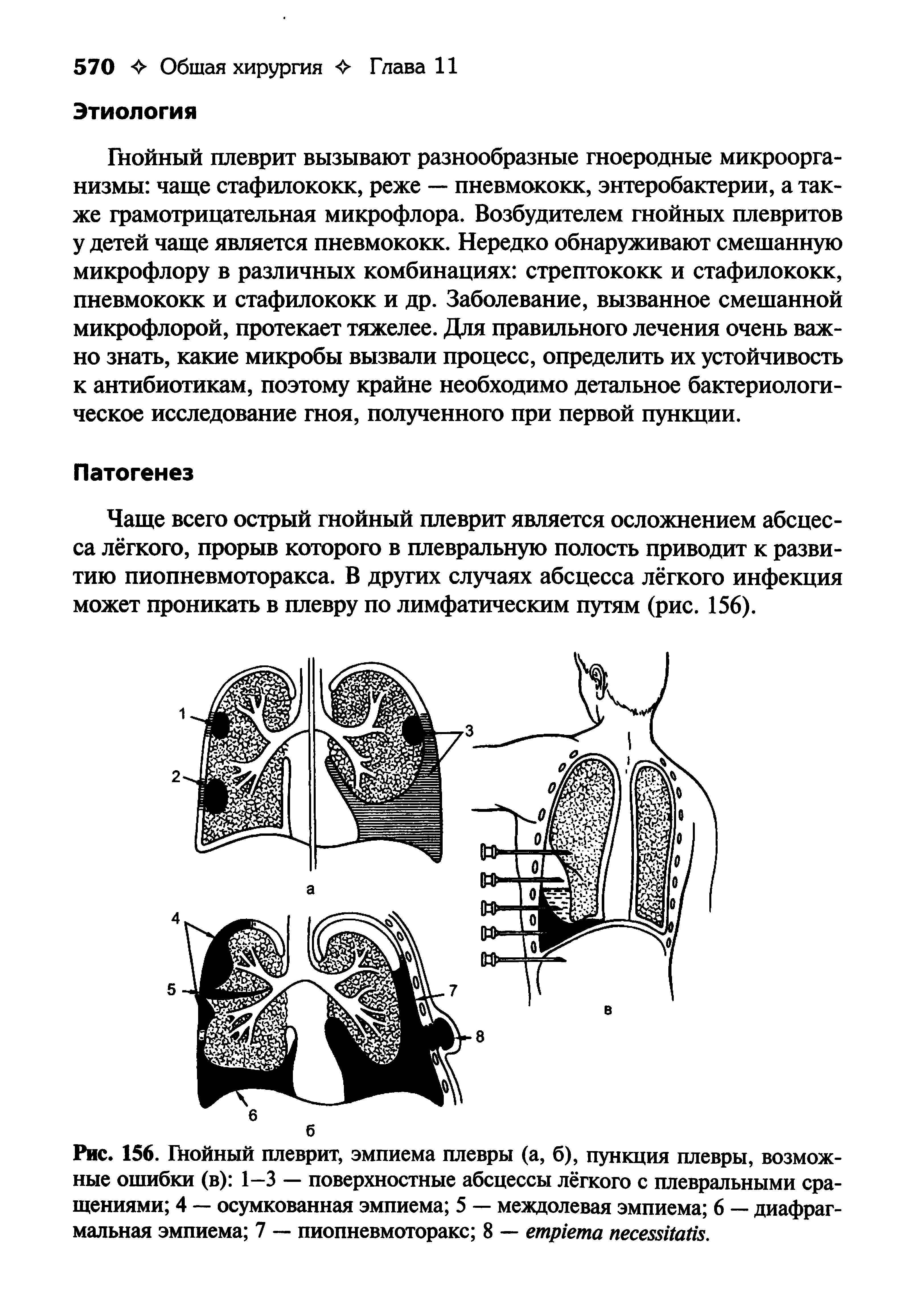 Рис. 156. Пюйный плеврит, эмпиема плевры (а, б), пункция плевры, возможные ошибки (в) 1—3 — поверхностные абсцессы лёгкого с плевральными сращениями 4 — осумкованная эмпиема 5 — междолевая эмпиема 6 — диафрагмальная эмпиема 7 — пиопневмоторакс 8 — .