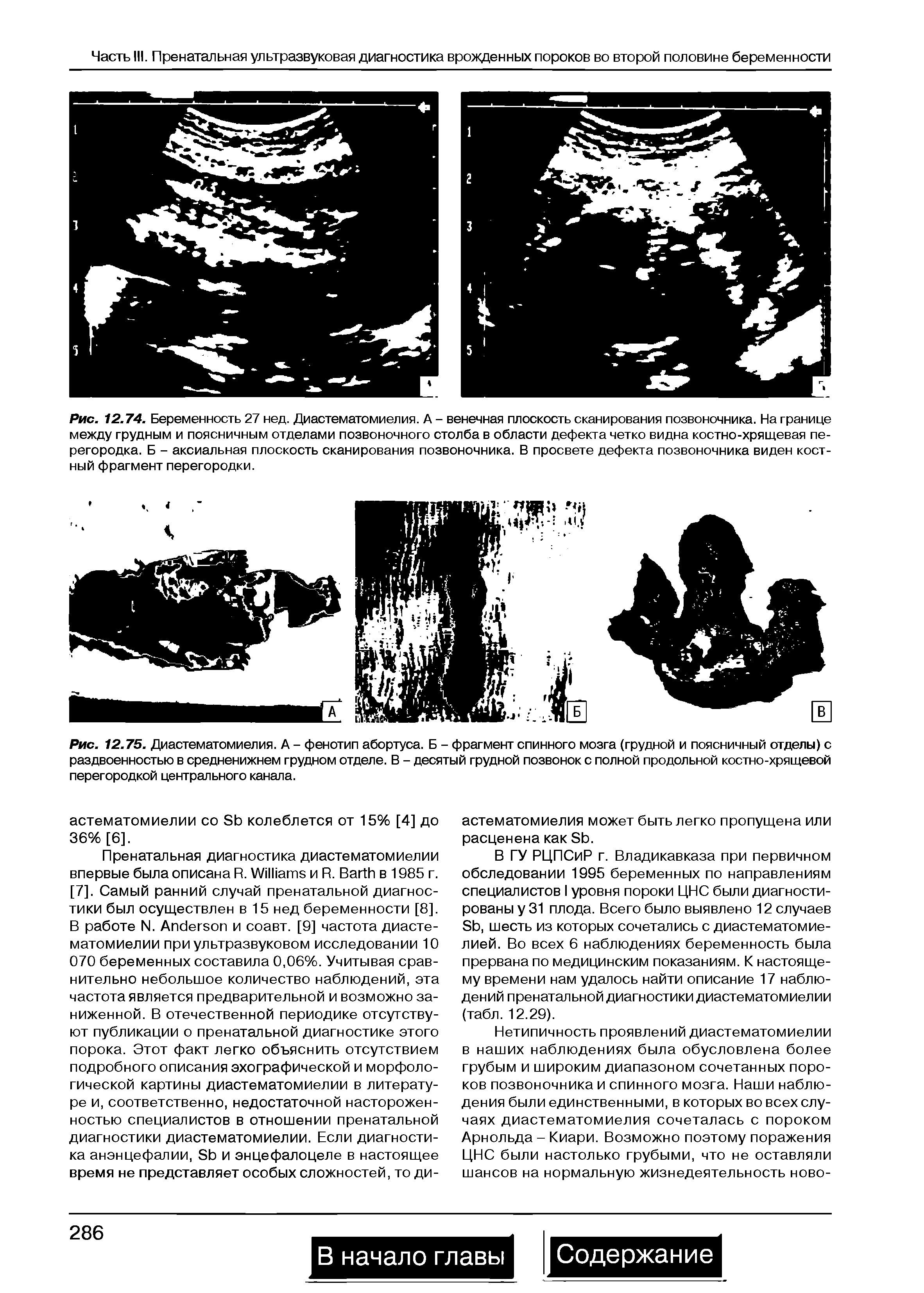 Рис. 12.75. Диастематомиелия. А - фенотип абортуса. Б - фрагмент спинного мозга (грудной и поясничный отделы) с раздвоенностью в средненижнем грудном отделе. В - десятый грудной позвонок с полной продольной костно-хрящевой перегородкой центрального канала.