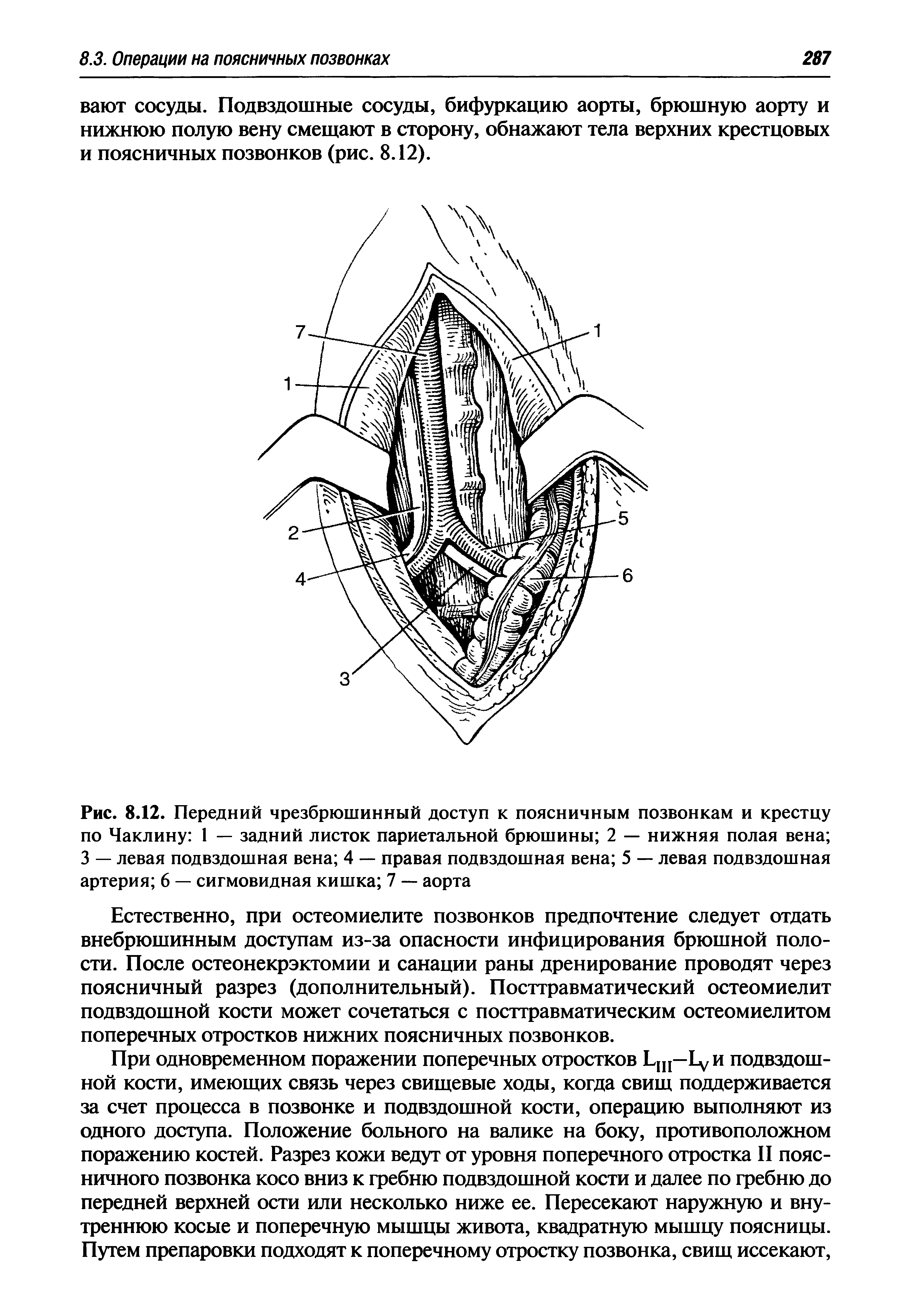 Рис. 8.12. Передний чрезбрюшинный доступ к поясничным позвонкам и крестцу по Чаклину 1 — задний листок париетальной брюшины 2 — нижняя полая вена 3 — левая подвздошная вена 4 — правая подвздошная вена 5 — левая подвздошная артерия 6 — сигмовидная кишка 7 — аорта...