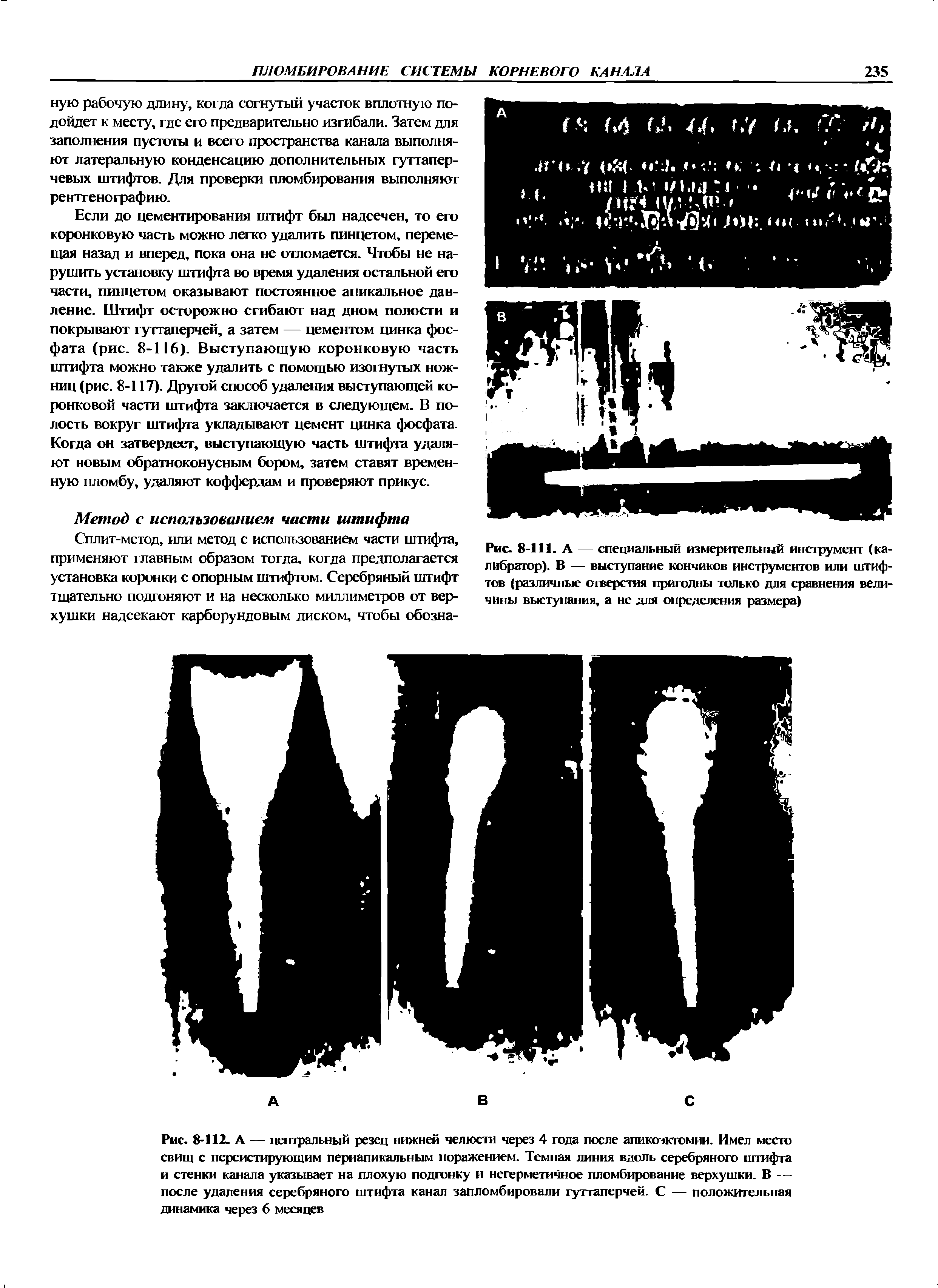 Рис. 8-111. А — специальный измерительный инструмент (калибратор). В — выступание кончиков инструментов или штифтов (различные отверстия пригодны только для сравнения величины выступания, а не для определения размера)...