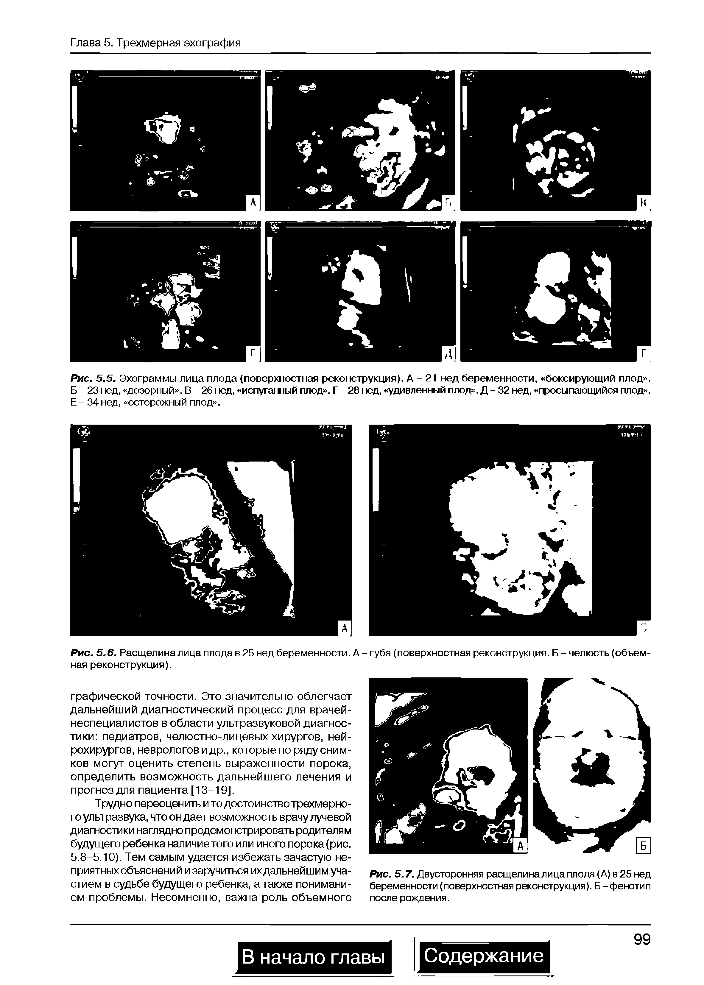 Рис. 5.6. Расщелина лица плода в 25 нед беременности. А - губа (поверхностная реконструкция. Б - челюсть (объемная реконструкция).