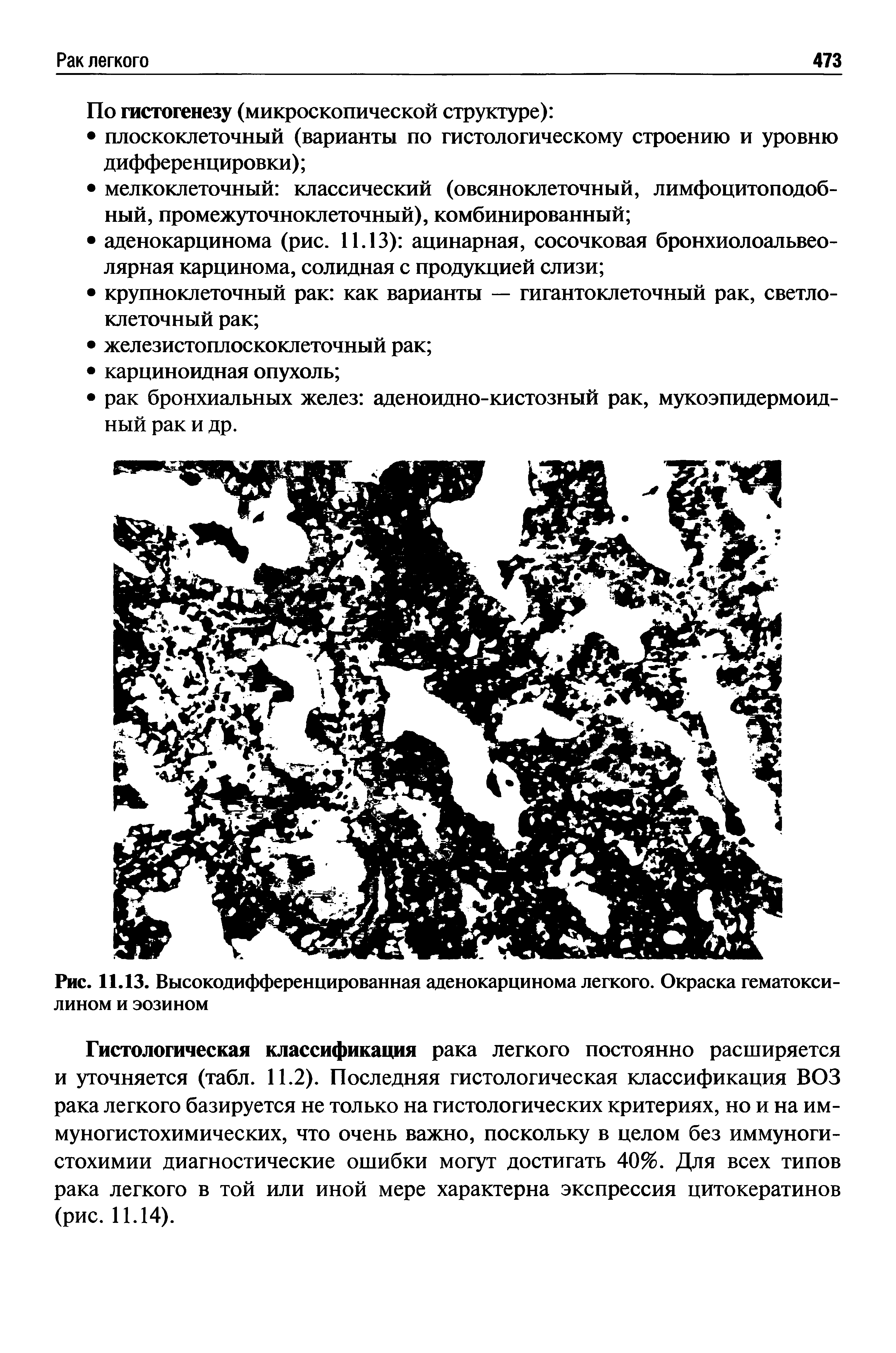 Рис. 11.13. Высокодифференцированная аденокарцинома легкого. Окраска гематоксилином и эозином...