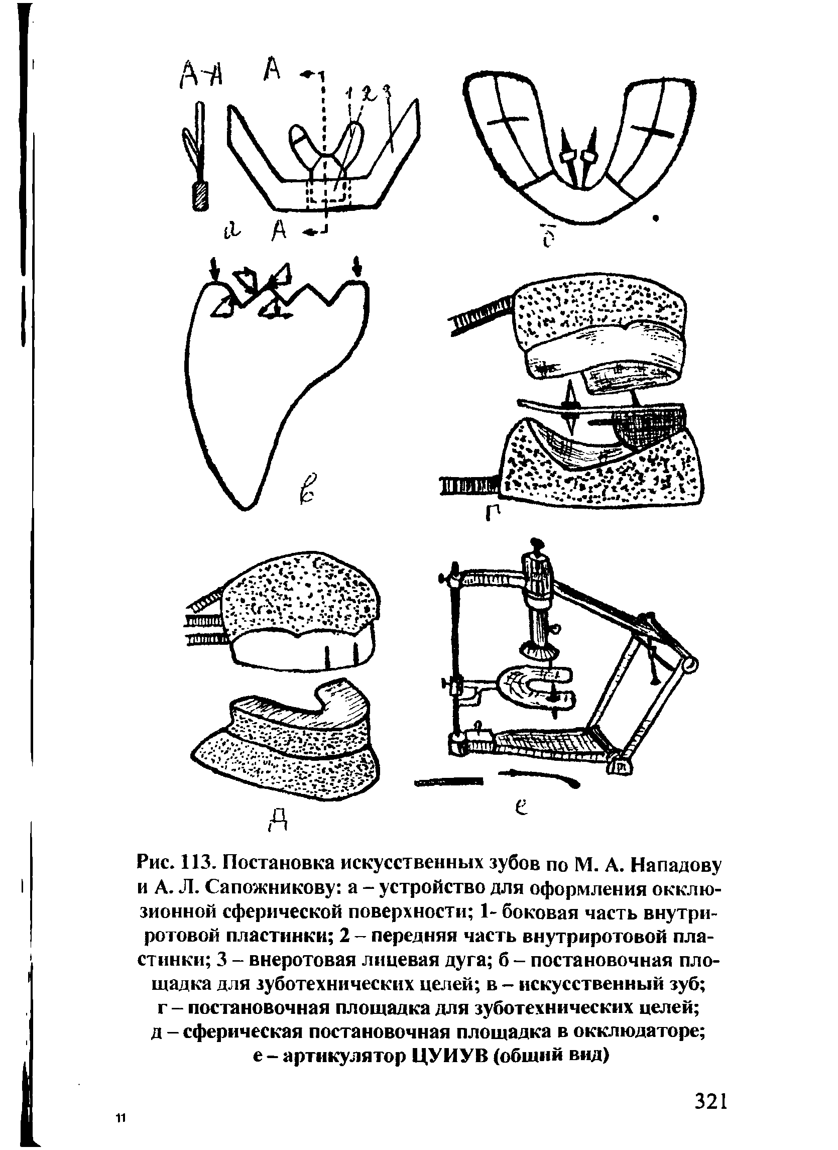 Рис. 113. Постановка искусственных зубов по М. А. Нападову и А. Л. Сапожникову а - устройство для оформления окклюзионной сферической поверхности 1- боковая часть внутри-ротовой пластинки 2 - передняя часть внутриротовой пластинки 3 - внеротовая лицевая дуга б - постановочная площадка для зуботехнических целей в - искусственный зуб г - постановочная площадка для зуботехнических целей ...