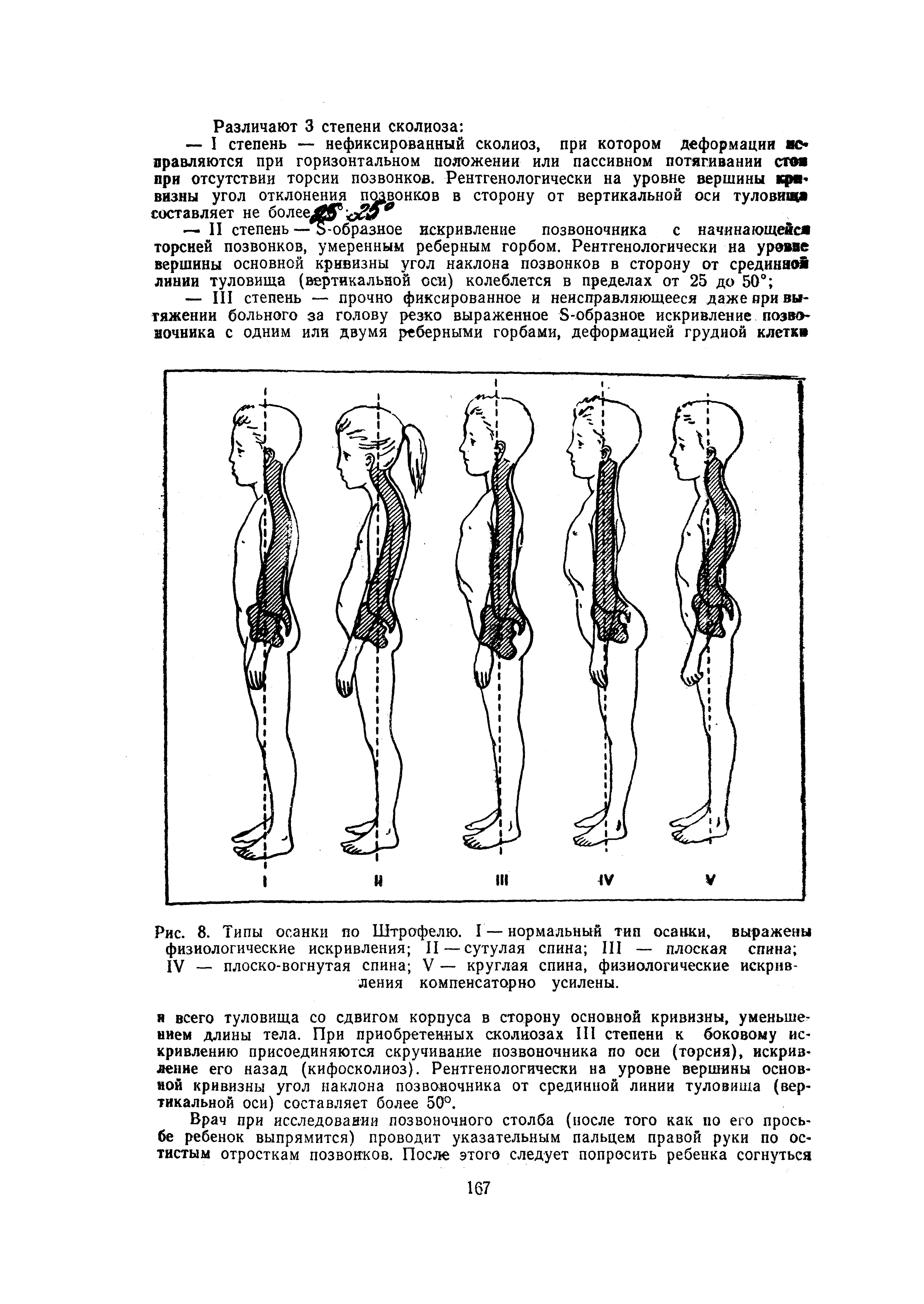 Рис. 8. Типы осанки по Штрофелю. I — нормальный тип осанки, выражены физиологические искривления II — сутулая спина III — плоская спина IV — плоско-вогнутая спина V — круглая спина, физиологические искривления компенсаторно усилены.