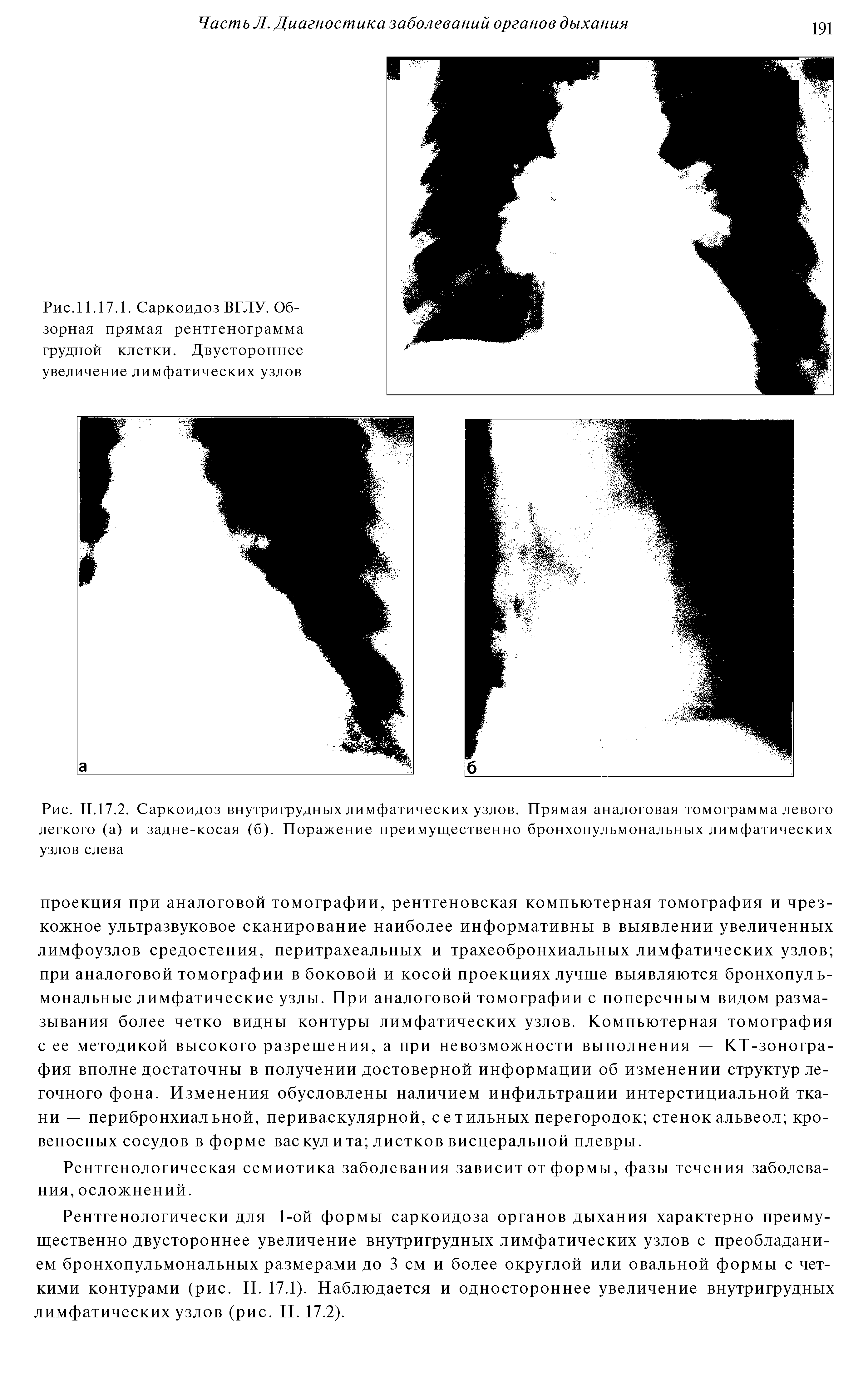 Рис. II.17.2. Саркоидоз внутригрудных лимфатических узлов. Прямая аналоговая томограмма левого легкого (а) и задне-косая (б). Поражение преимущественно бронхопульмональных лимфатических узлов слева...