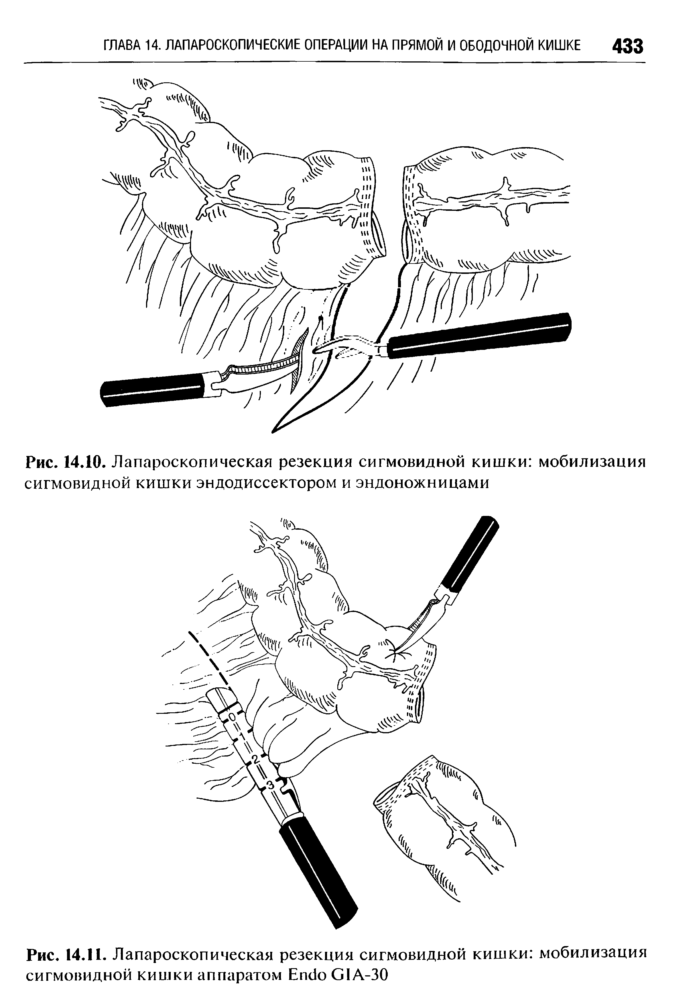 Рис. 14.10. Лапароскопическая резекция сигмовидной кишки мобилизация сигмовидной кишки эндодиссектором и эндоножницами...