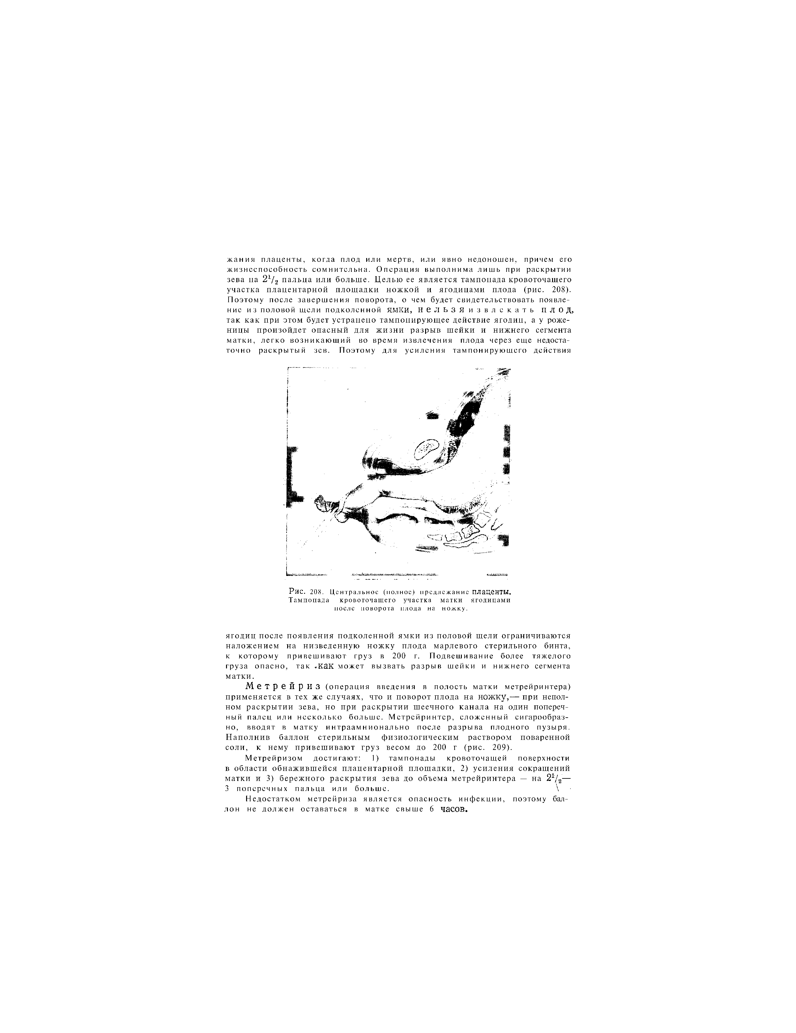 Рис. 208. Центральное (полное) предлежание ПЛЗЦеНТЫ, Тампонада кровоточащего участка матки ягодицами после поворота плода на ножку.