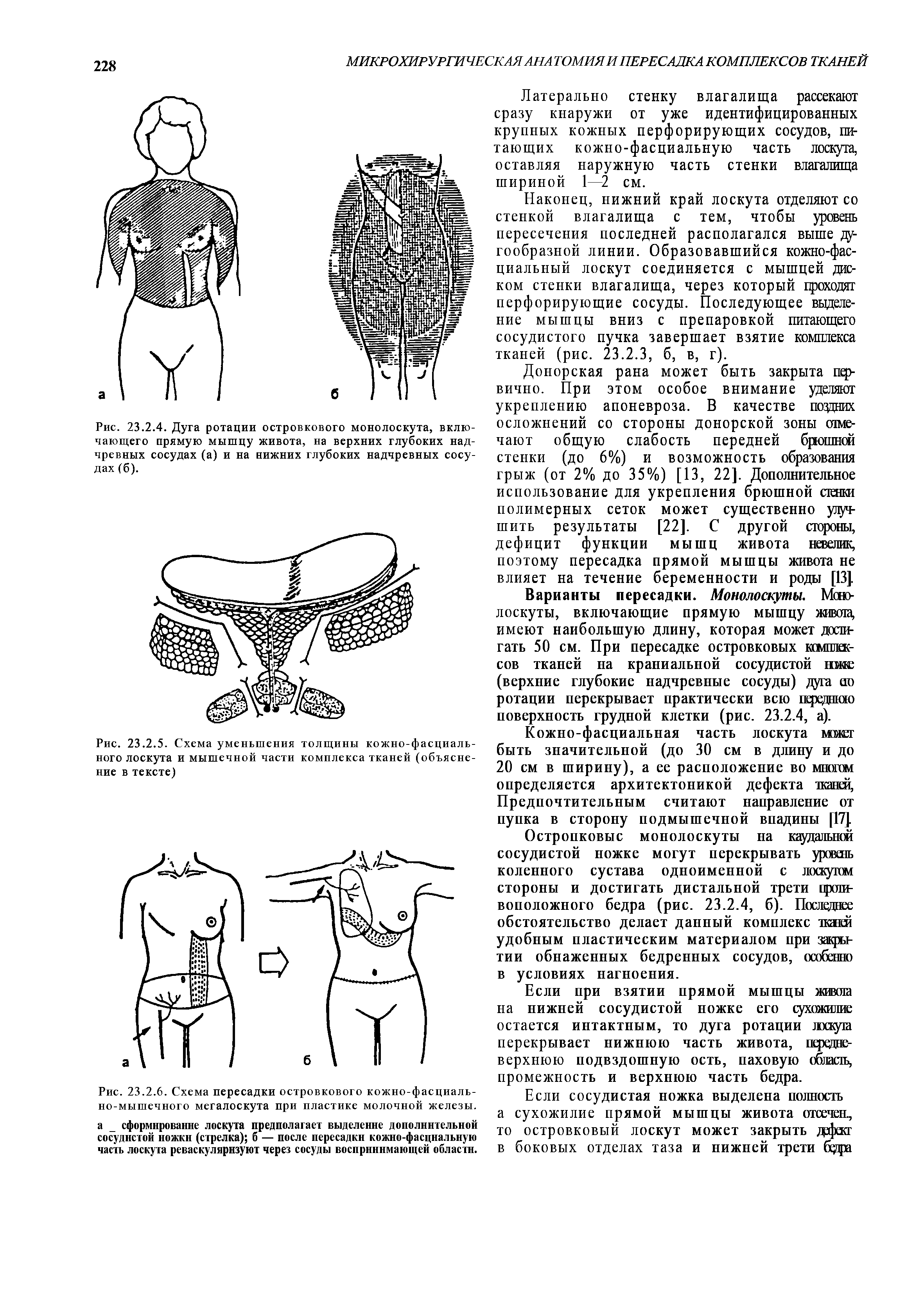 Рис. 23.2.6. Схема пересадки островкового кожно-фасциаль-но-мышечного мегалоскута при пластике молочной железы, а сформирование лоскута предполагает выделение дополнительной сосудистой ножкн (стрелка) б — после пересадки кожно-фасциальную часть лоскута реваскулярнзуют через сосуды воспринимающей области.