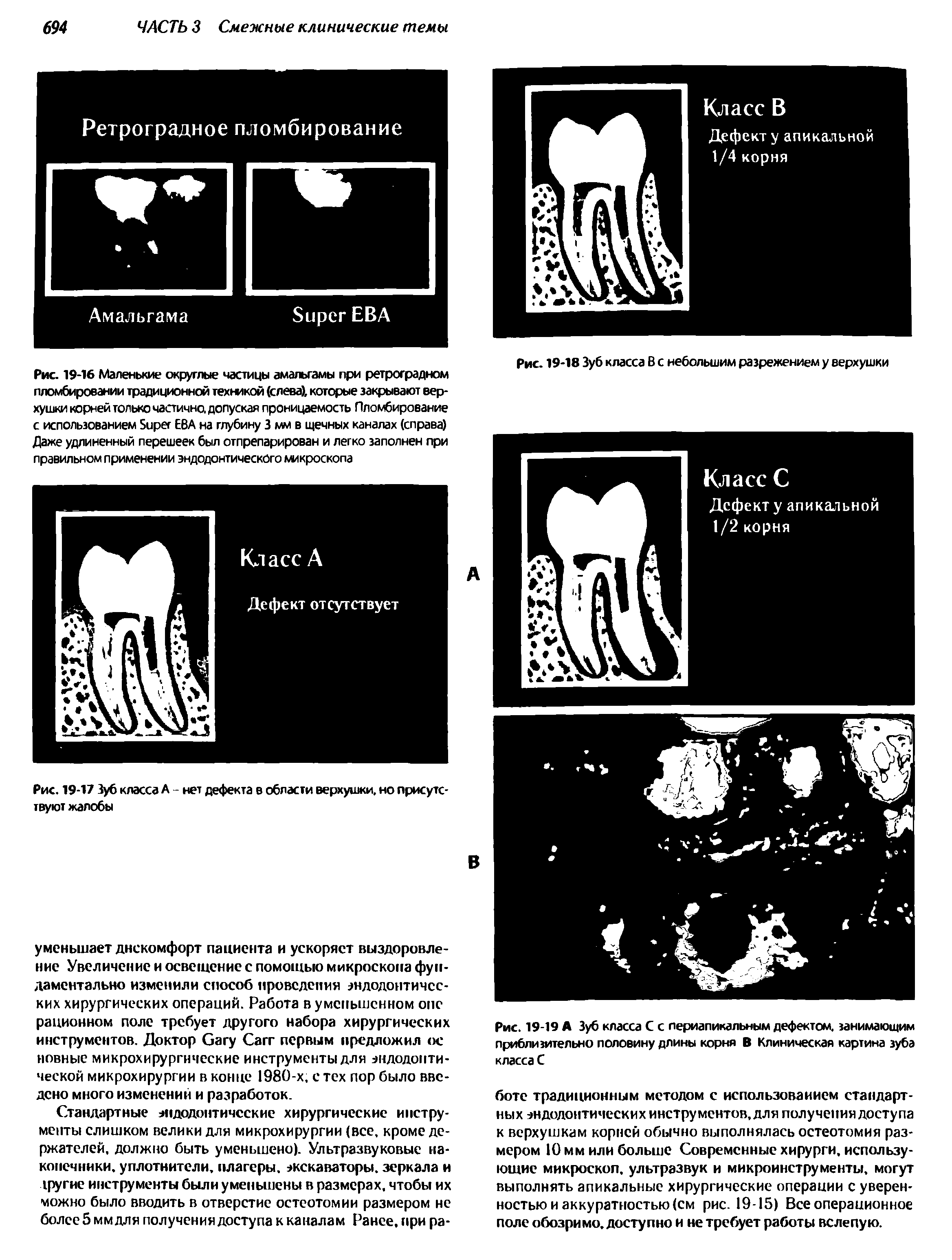 Рис. 19-19 А Зуб класса С с периапикальным дефектом, занимающим приблизительно половину длины корня В Клиническая картина зуба класса С...