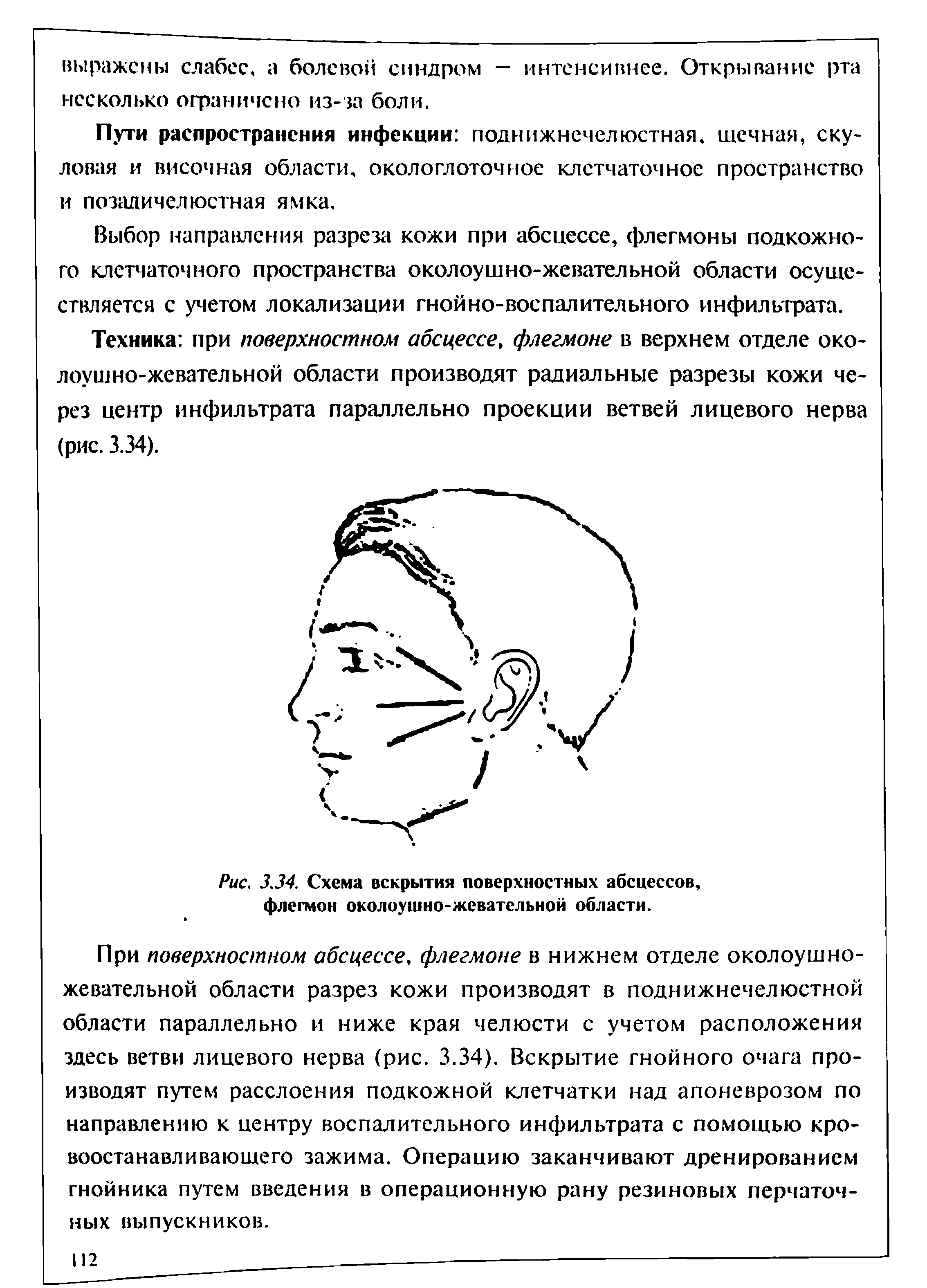 Рис. 3.34. Схема вскрытия поверхностных абсцессов, флегмон околоушно-жевательной области.