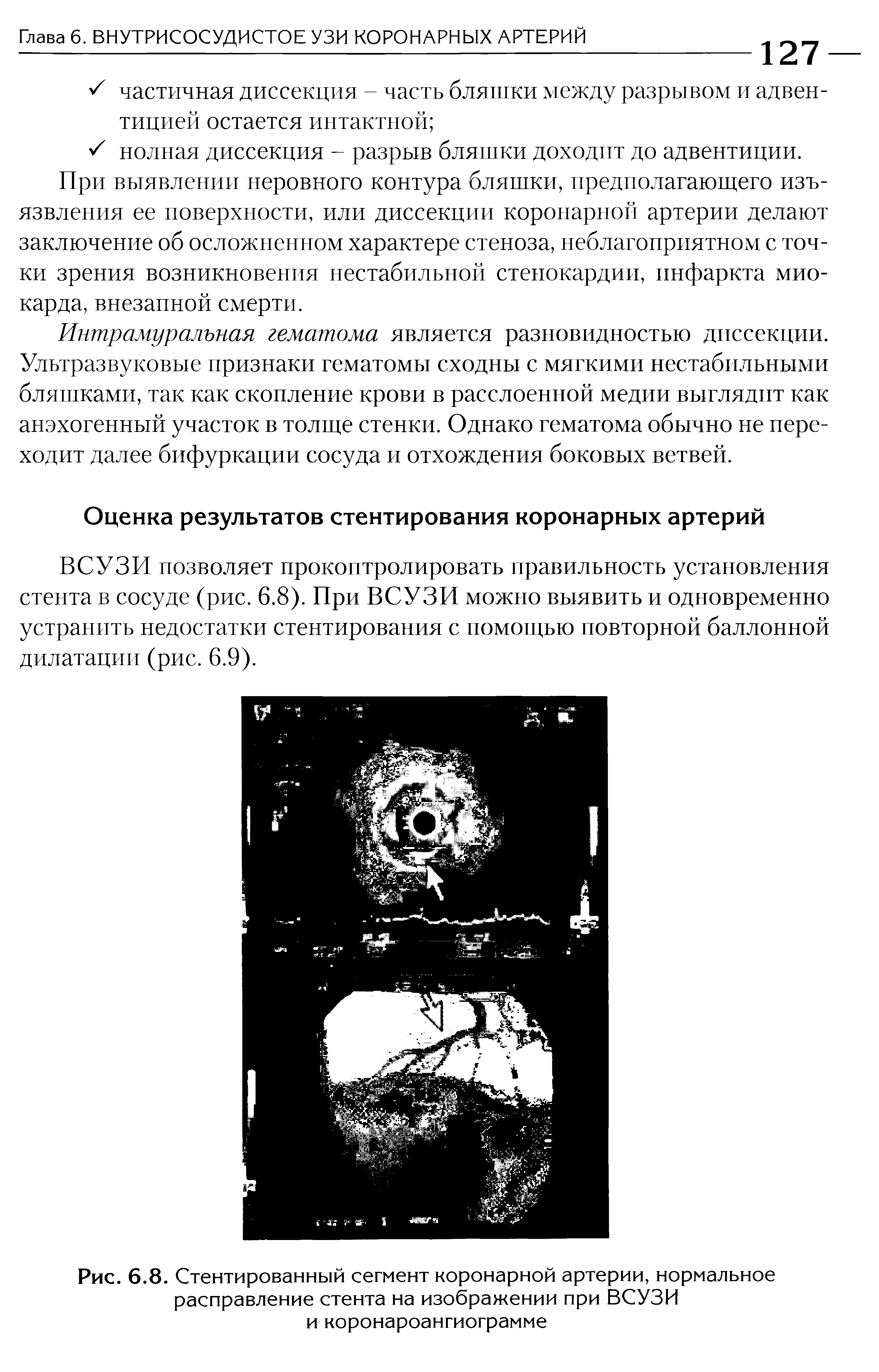 Рис. 6.8. Стентированный сегмент коронарной артерии, нормальное расправление стента на изображении при ВСУЗИ и коронароангиограмме...