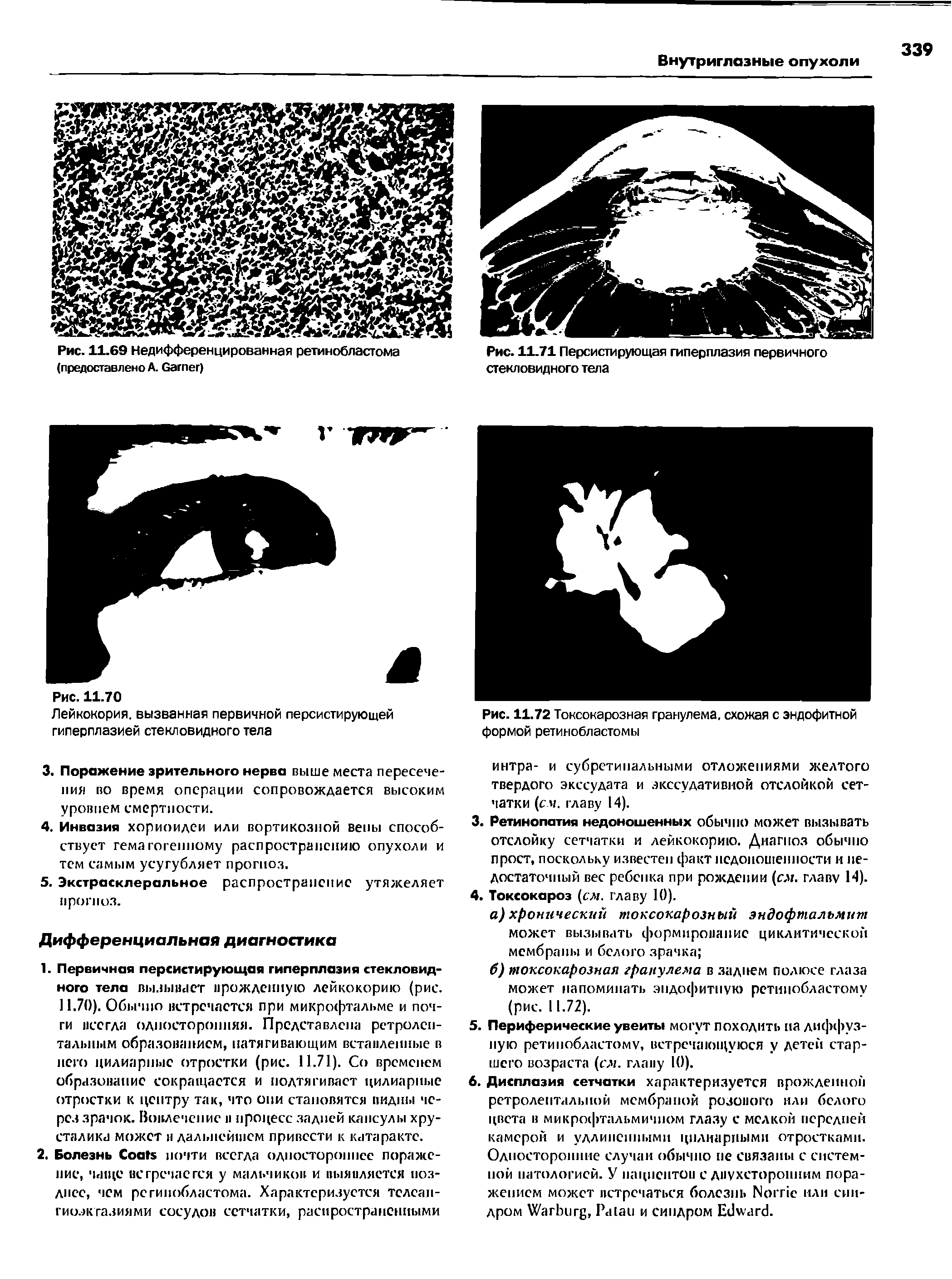 Рис. 11.72 Токсокарозная гранулема, схожая с эндофитной формой ретинобластомы...