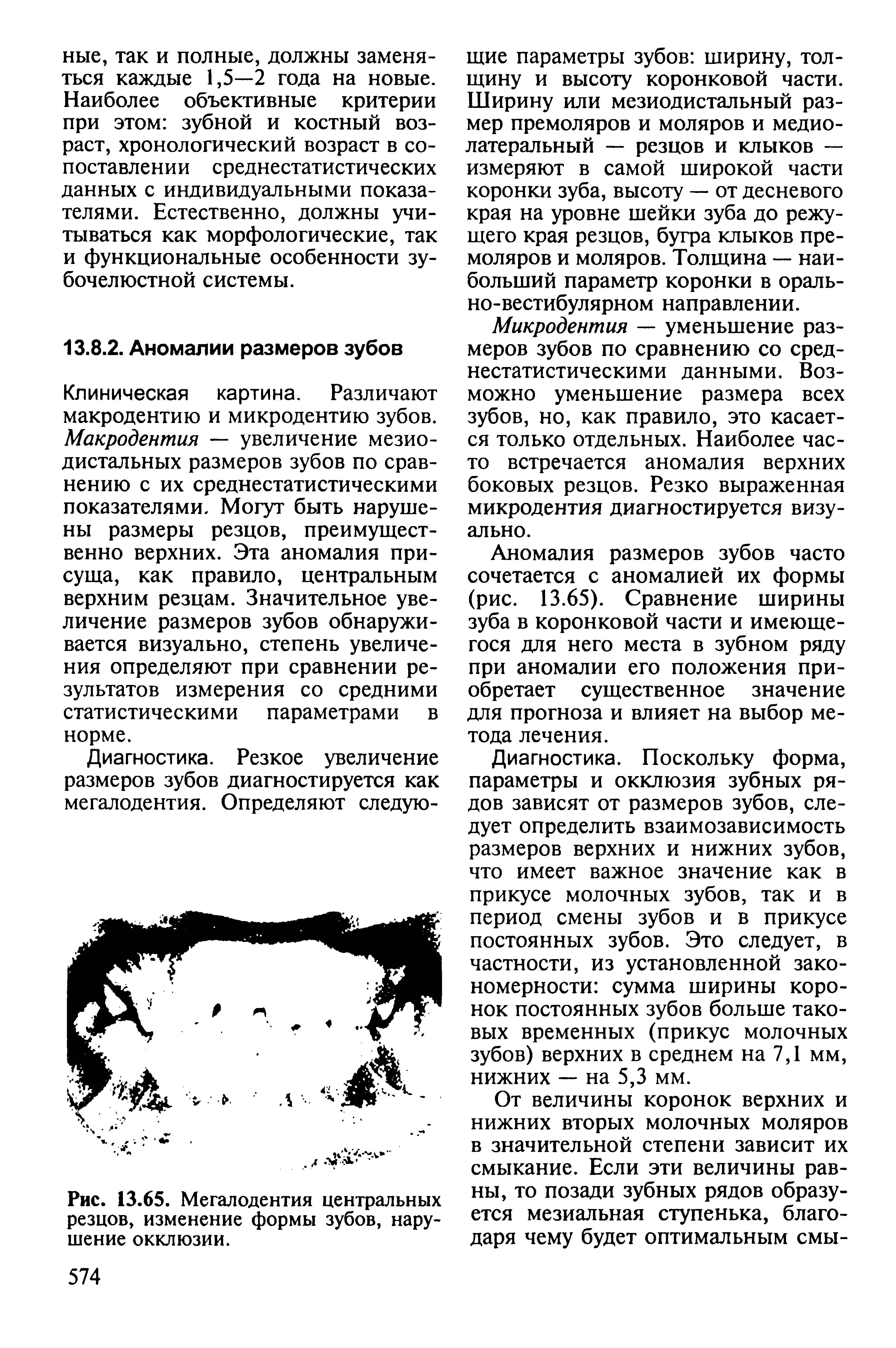 Рис. 13.65. Мегалодентия центральных резцов, изменение формы зубов, нарушение окклюзии.