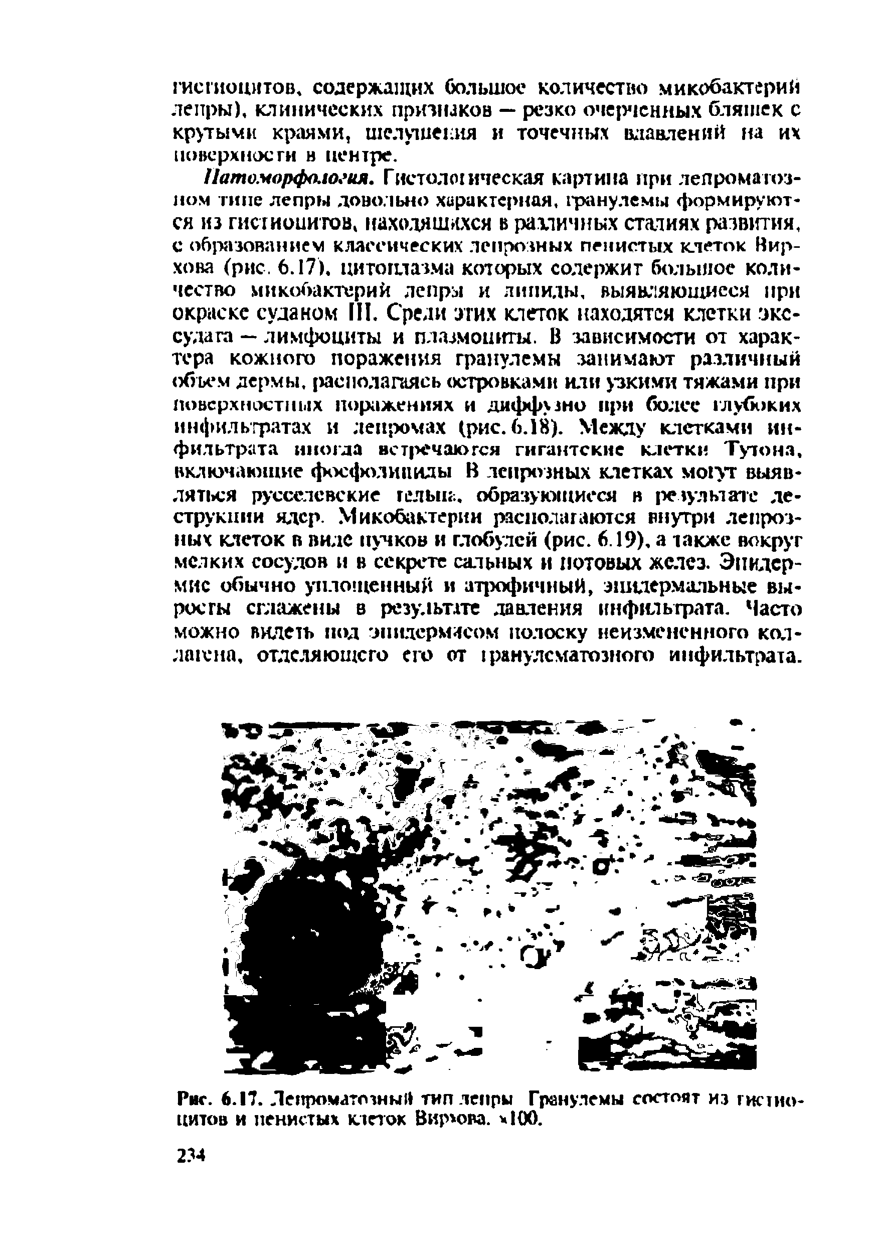 Рис. 6.17. Лепроматозный тип лепры Гранулемы состоят из гистиоцитов и пенистых клеток Вирмзва. 100.