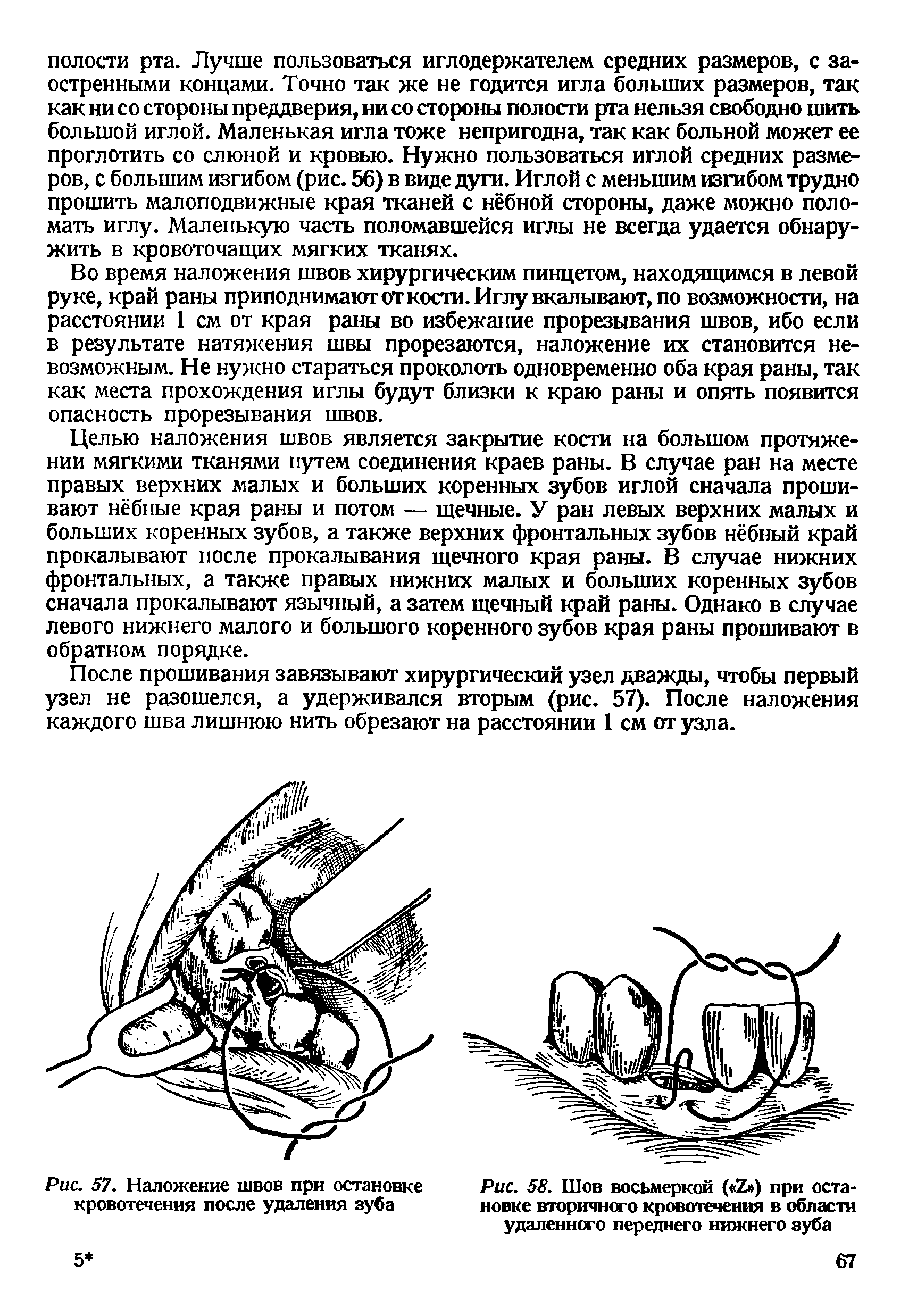 Рис. 57. Наложение швов при остановке кровотечения после удаления зуба...