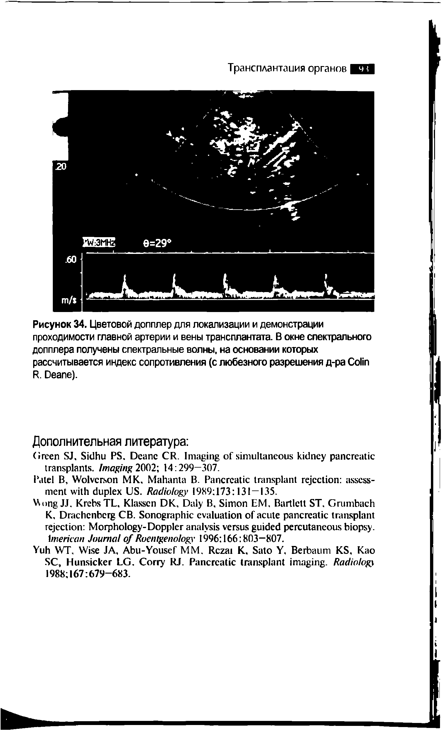 Рисунок 34. Цветовой допплер для локализации и демонстрации проходимости главной артерии и вены трансплантата. В окне спектрального допплера получены спектральные волны, на основании которых рассчитывается индекс сопротивления (с любезного разрешения д-ра C R. D ).