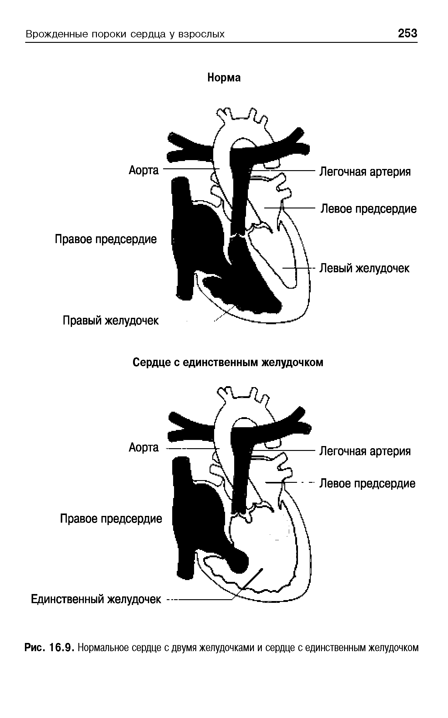 Рис. 16.9. Нормальное сердце с двумя желудочками и сердце с единственным желудочком...