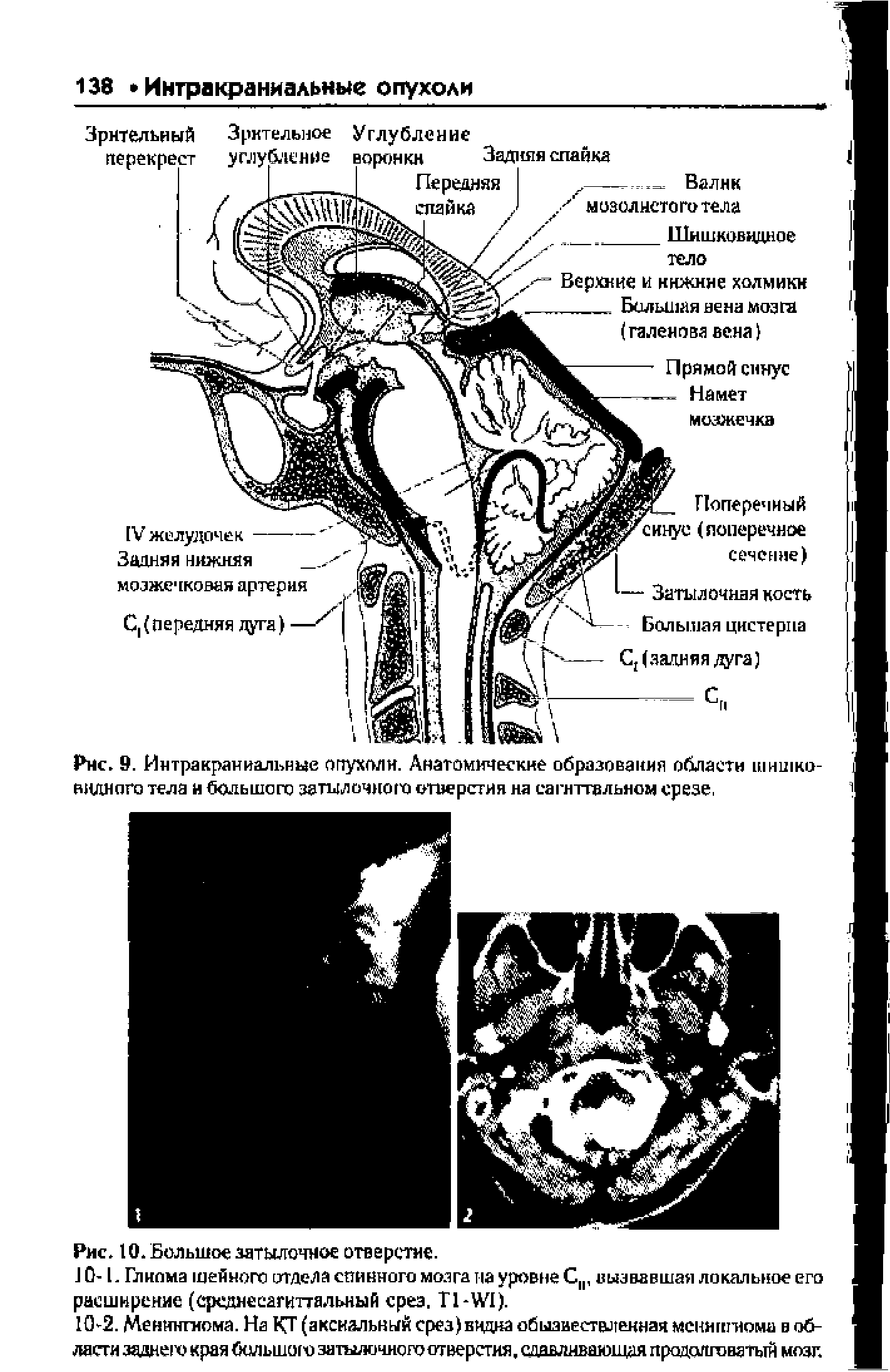 Рис. 9. Интракраниальные опухоли. Анатомические образования области шишковидного тела и большого затылочного отверстия на сагиттальном срезе,...