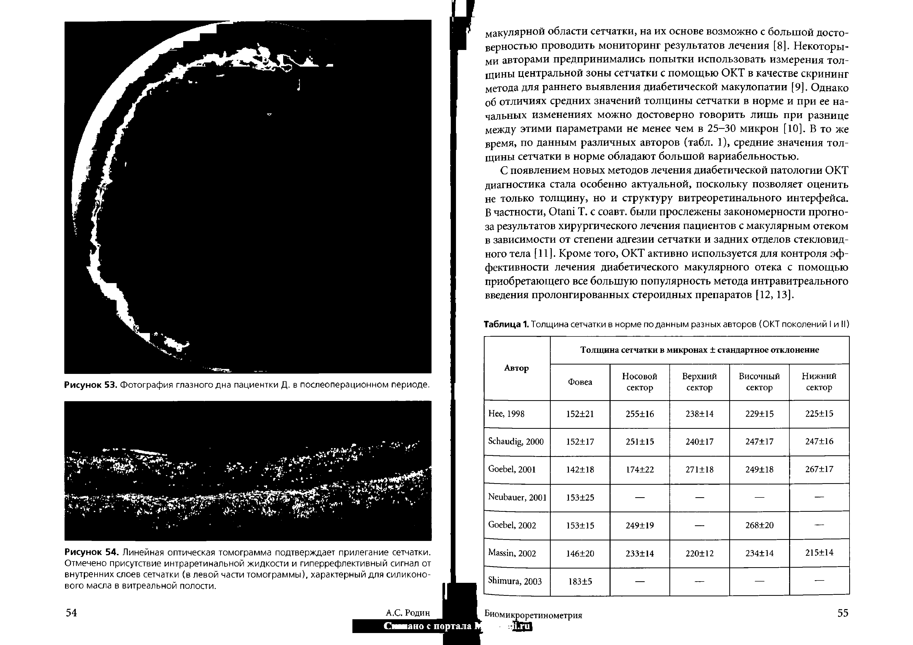 Таблица 1. Толщина сетчатки в норме поданным разных авторов (ОКТ поколений I и II)...