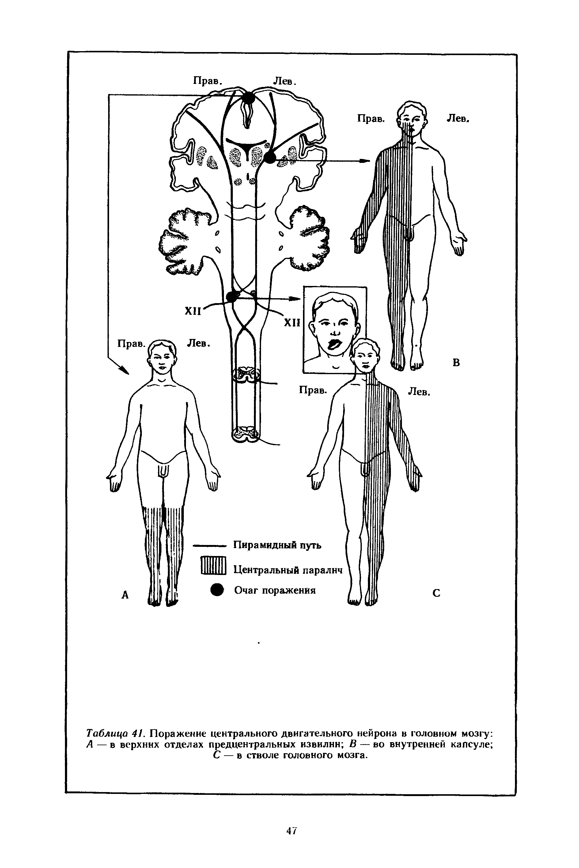 Таблица 41. Поражение центрального двигательного нейрона в головном мозгу А — в верхних отделах предцентральных извилин В — во внутренней капсуле С — в стволе головного мозга.