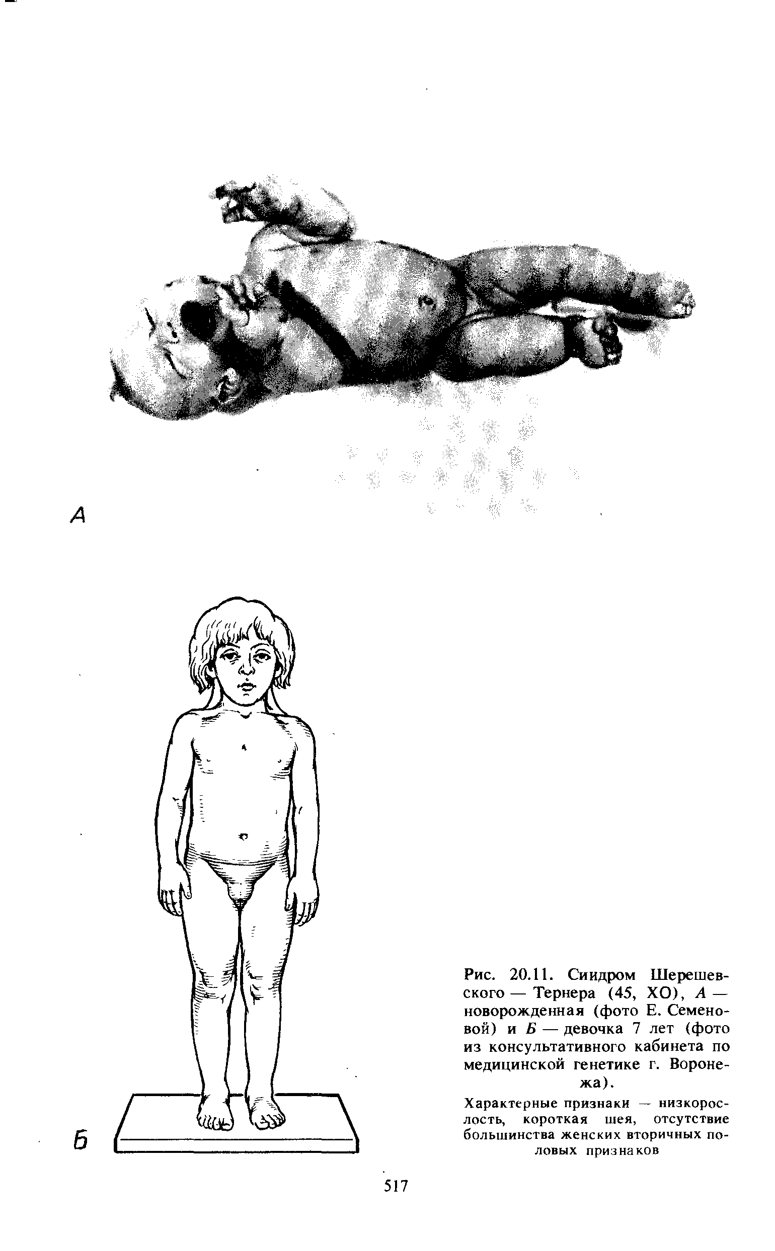 Рис. 20.11. Синдром Шерешев-ского — Тернера (45, ХО), А — новорожденная (фото Е. Семеновой) и В — девочка 7 лет (фото из консультативного кабинета по медицинской генетике г. Воронежа).