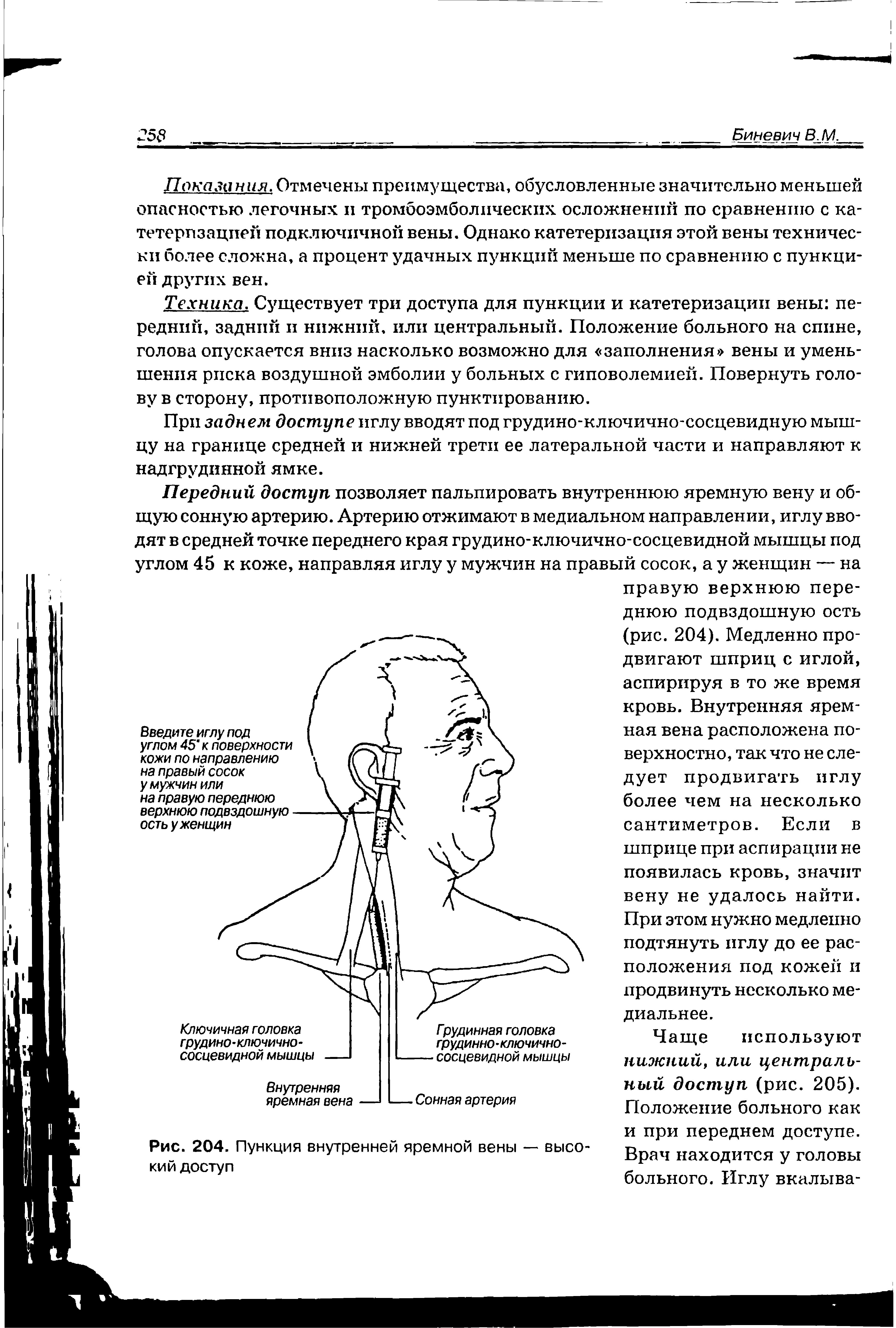 Рис. 204. Пункция внутренней яремной вены — высокий доступ...