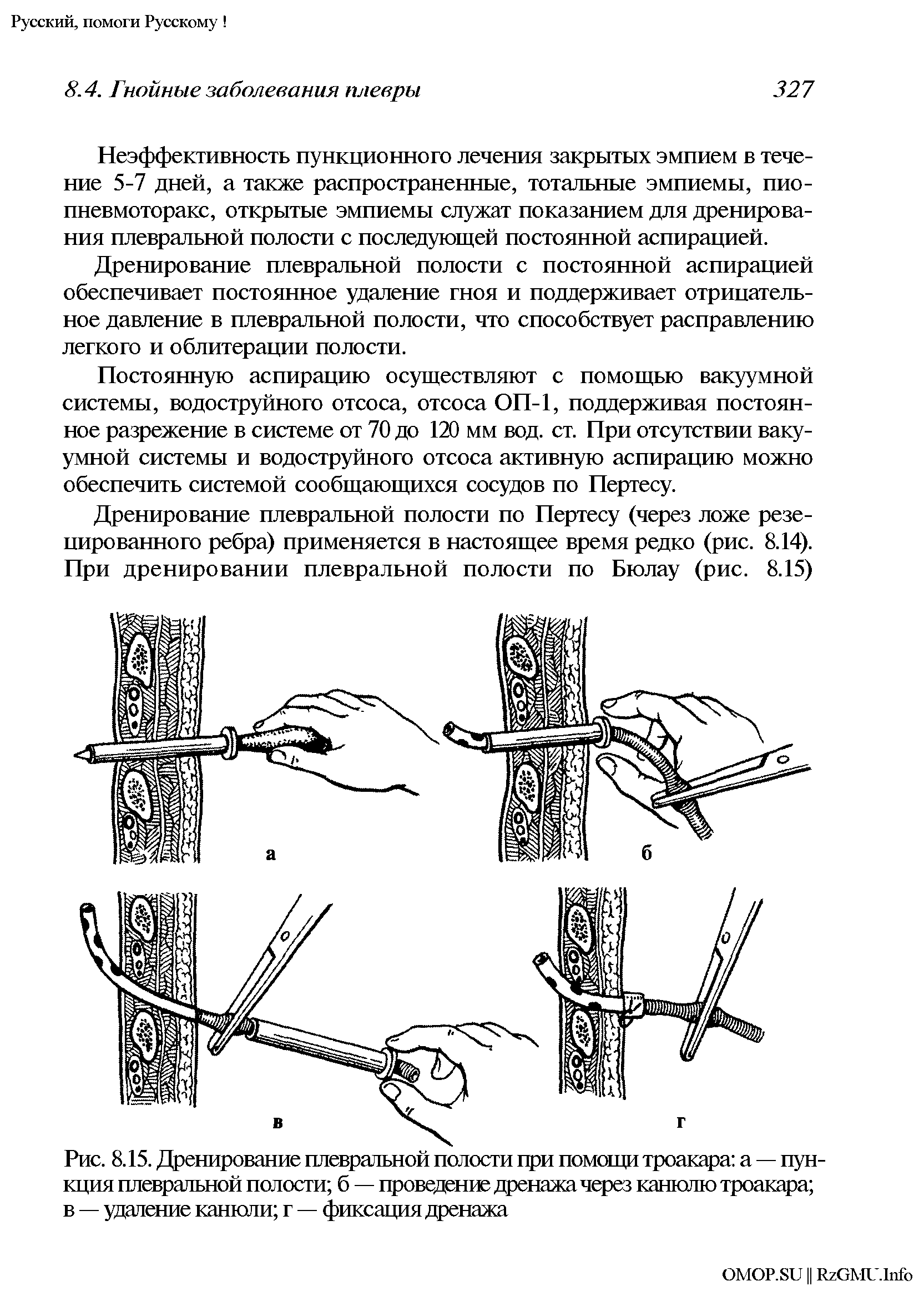 Рис. 8.15. Дренирование плевральной полости при помощи троакара а — пункция плевральной полости б — проведение дренажа через канюлю троакара в — удаление канюли г — фиксация дренажа...