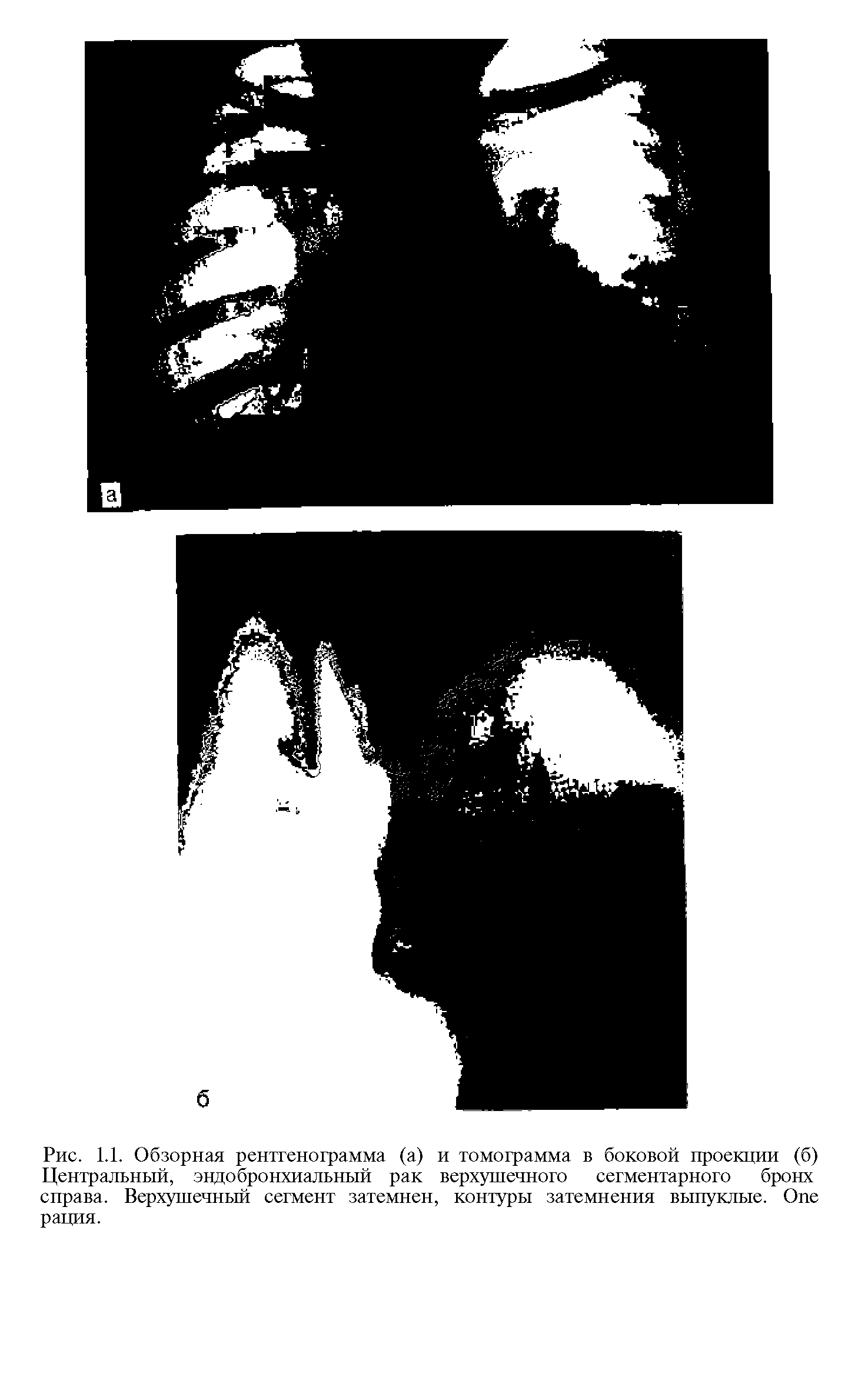 Рис. 1.1. Обзорная рентгенограмма (а) и томограмма в боковой проекции (б) Центральный, эндобронхиальный рак верхушечного сегментарного бронх справа. Верхушечный сегмент затемнен, контуры затемнения выпуклые. O рация.