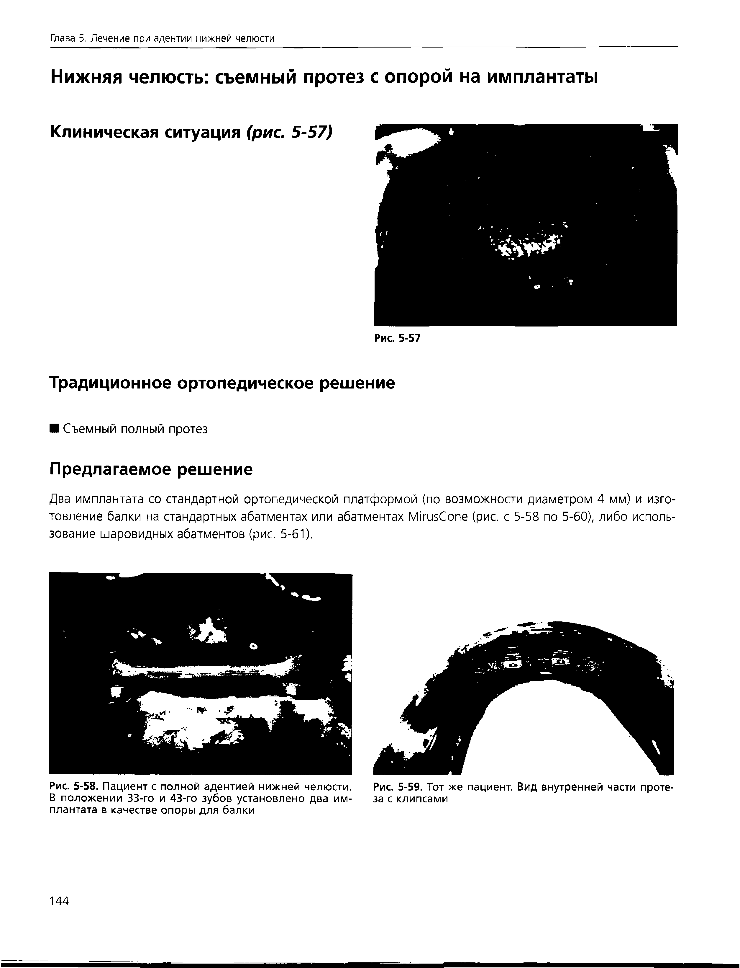 Рис. 5-58. Пациент с полной адентией нижней челюсти. Рис. 5-59. Тот же пациент. Вид внутренней части проте-В положении 33-го и 43-го зубов установлено два им- за с клипсами плантата в качестве опоры для балки...