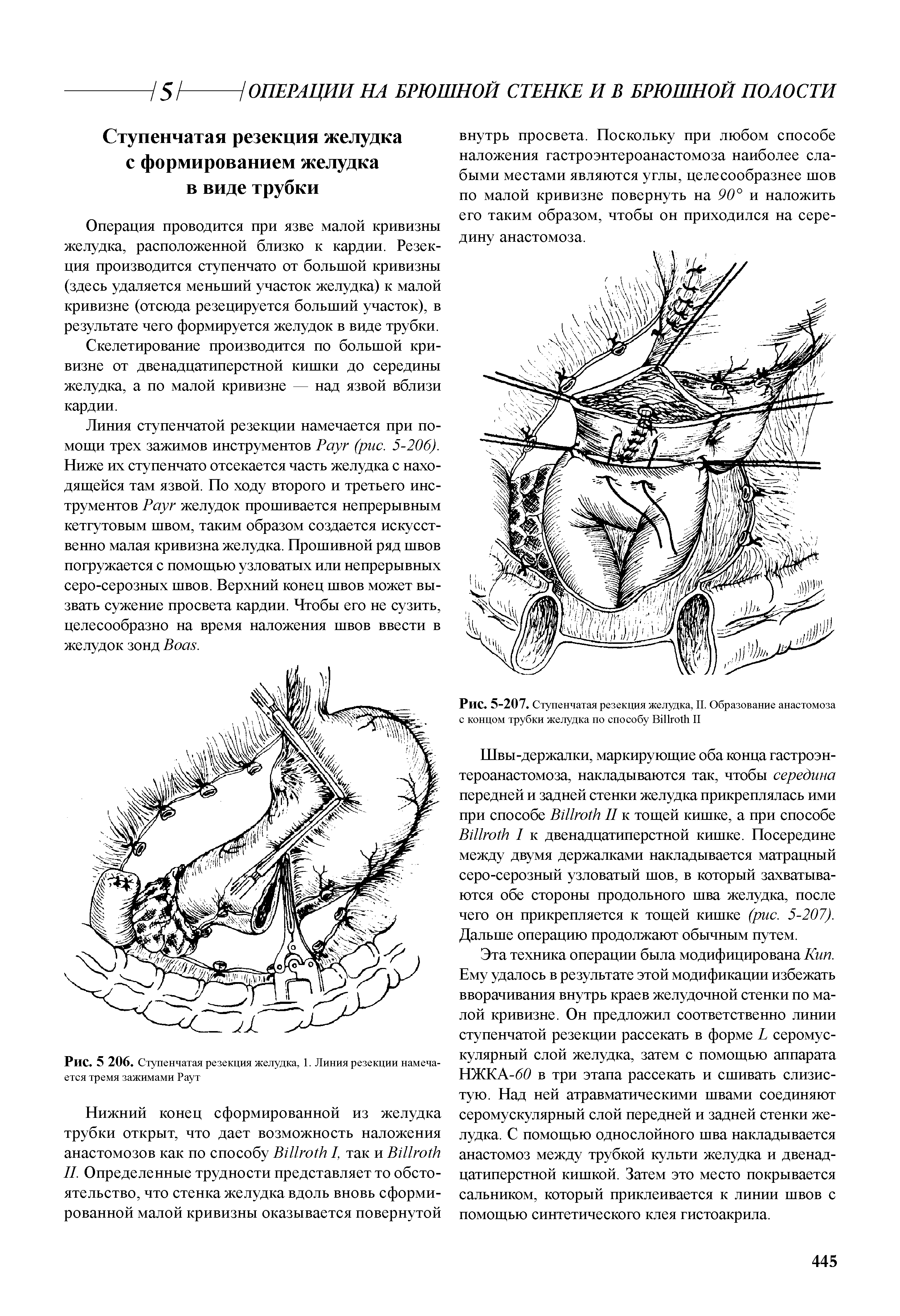 Рис. 5 206. Ступенчатая резекция желудка, 1. Линия резекции намеча-ется тремя зажимами Раут...